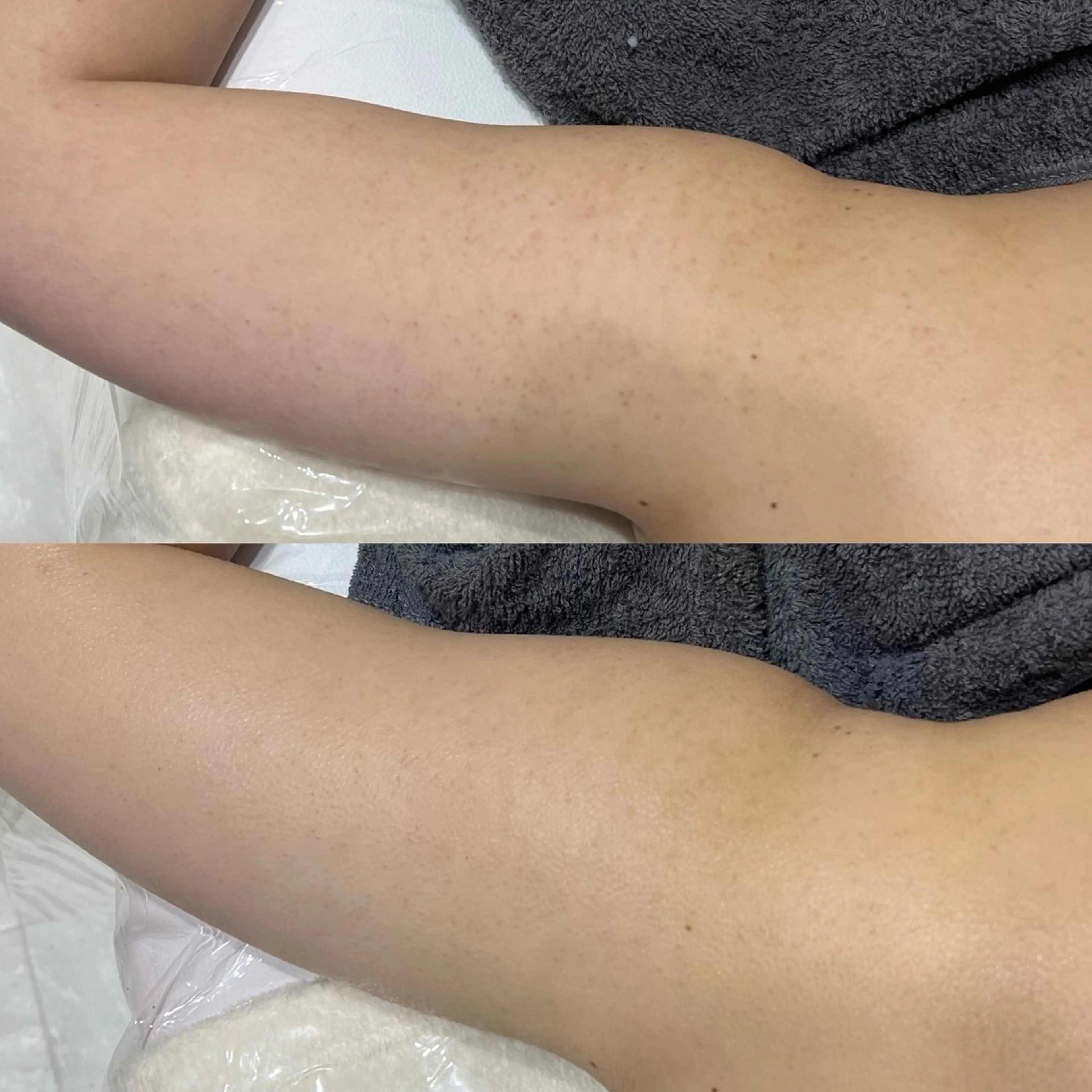 二の腕 💪🏻 REVIハーブピーリング《陶肌トリートメント》 / 頑固なブツブツ改善・乾燥にの写真