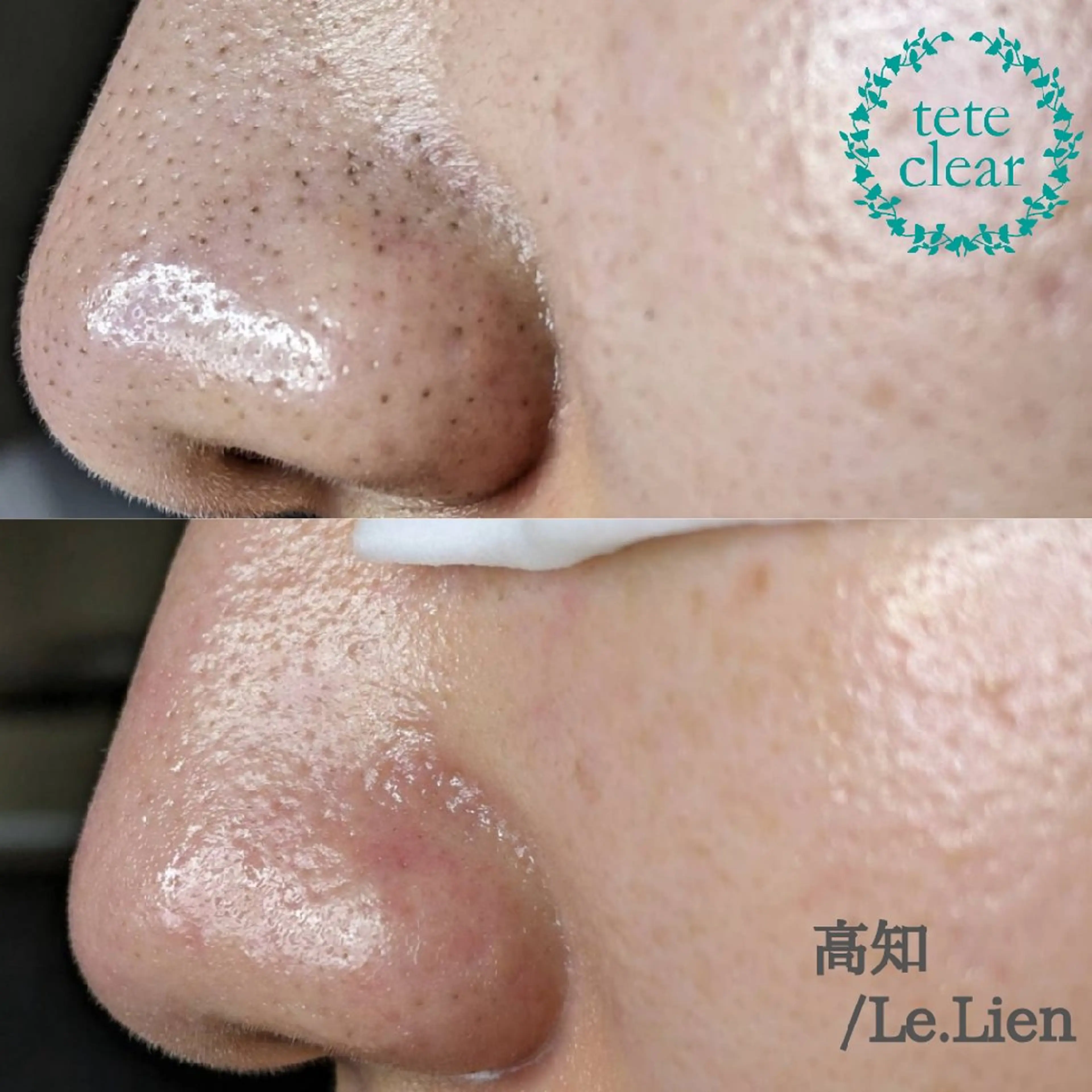 【脱いちご鼻✨】毛穴エクストラクション(施術時間70分)の写真