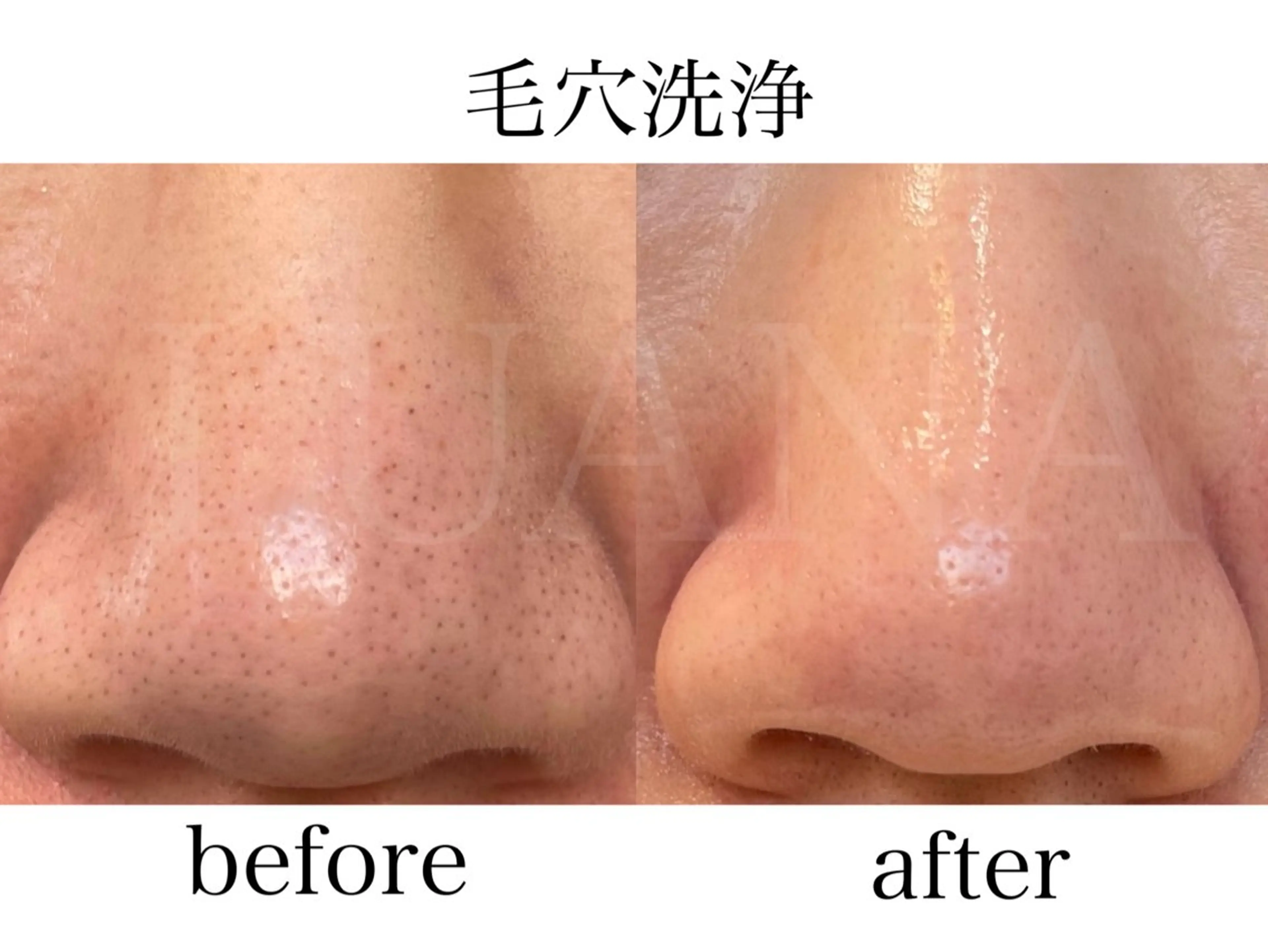 気になる黒ずみ毛穴に✨毛穴洗浄+韓国肌管理の写真