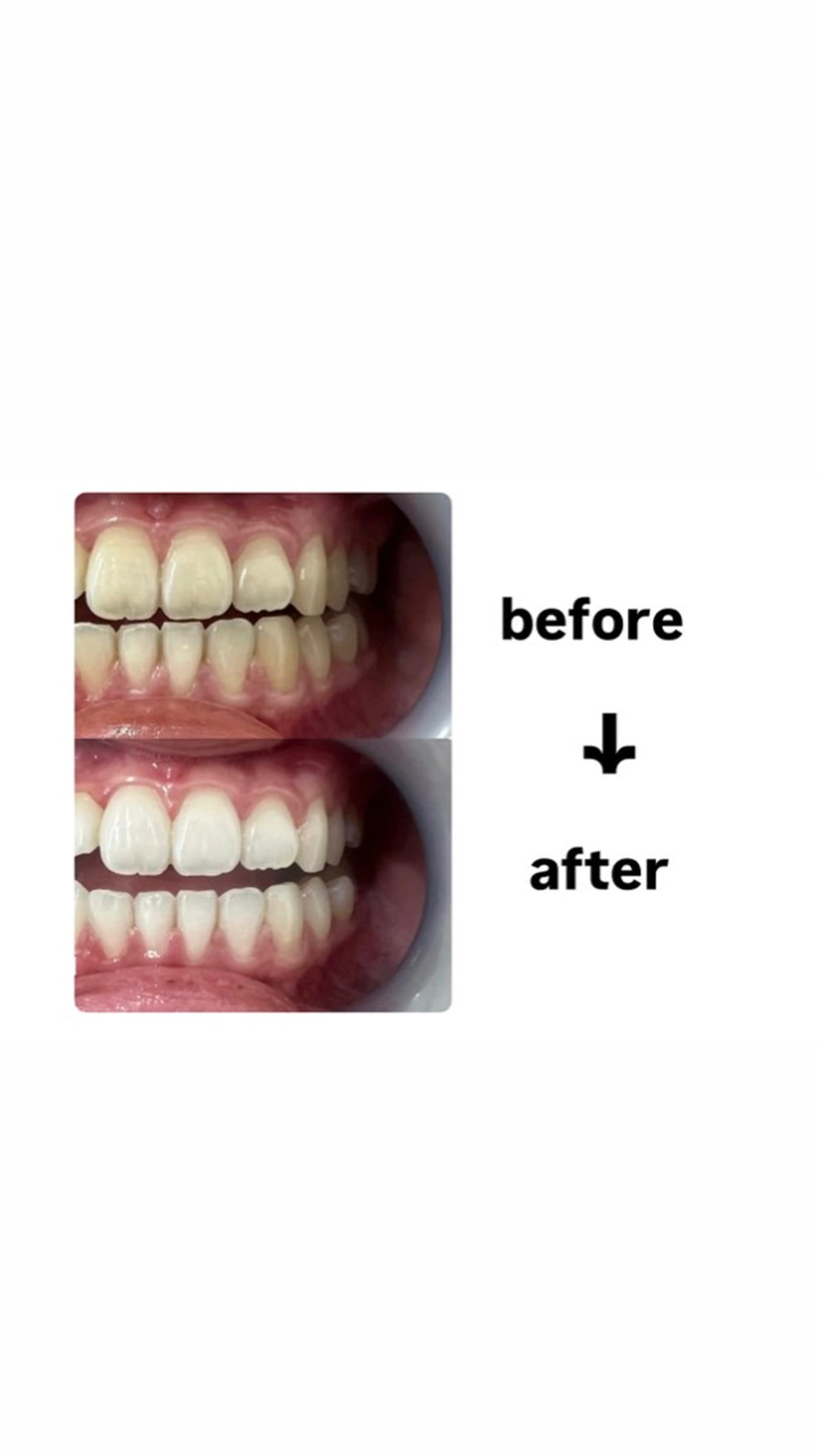 セルフホワイトニング 1日集中コースの写真