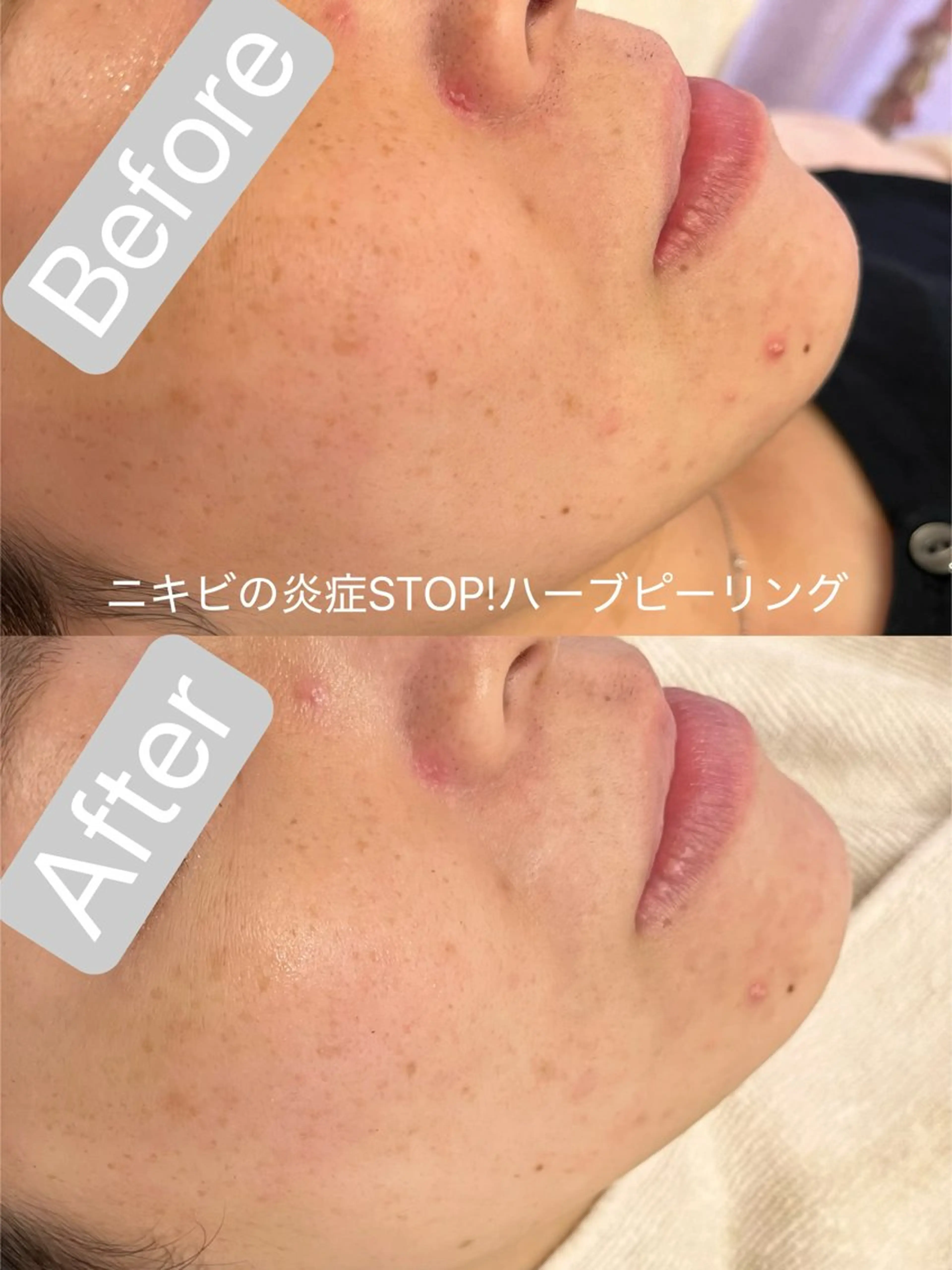 エステ アイラッシュ&エステサロンLinda西宮所属・小顔&毛穴・肌質改善 LINDA西宮 AIのその他イメージ