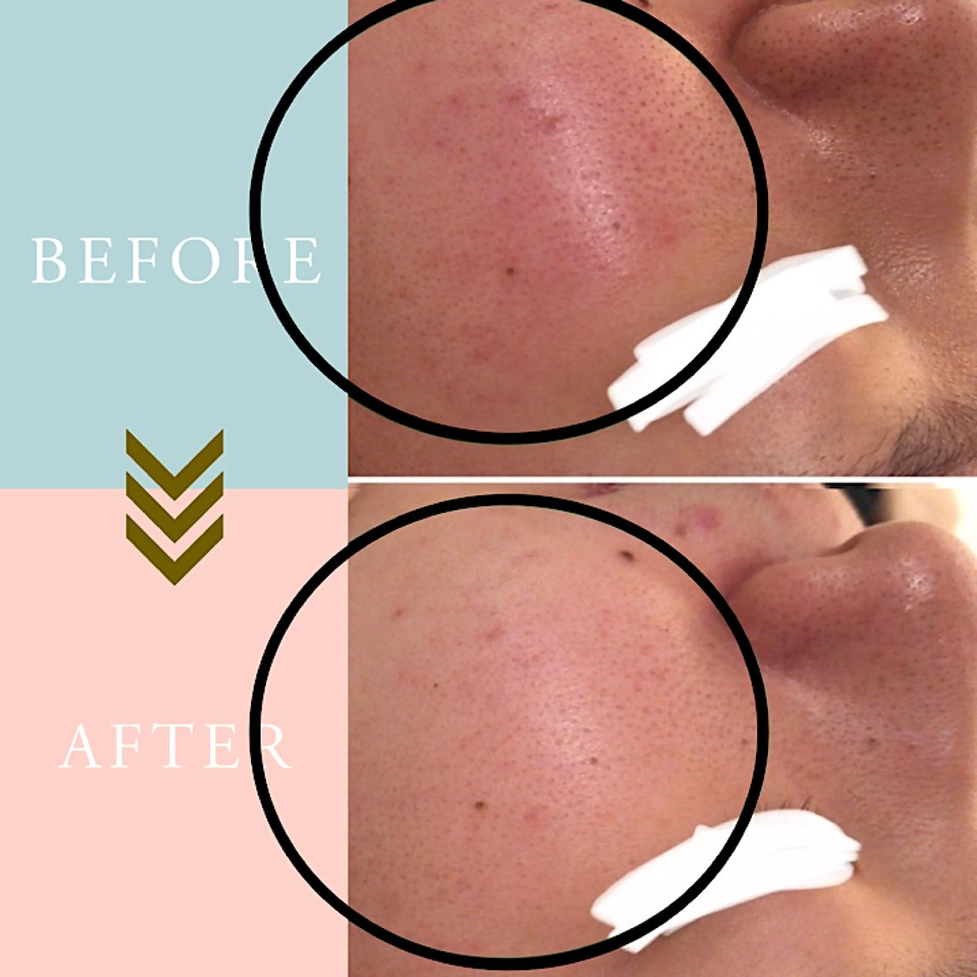 繰り返すニキビ・毛穴 ✨つくば肌質改善専門のエステ・リラクイメージ