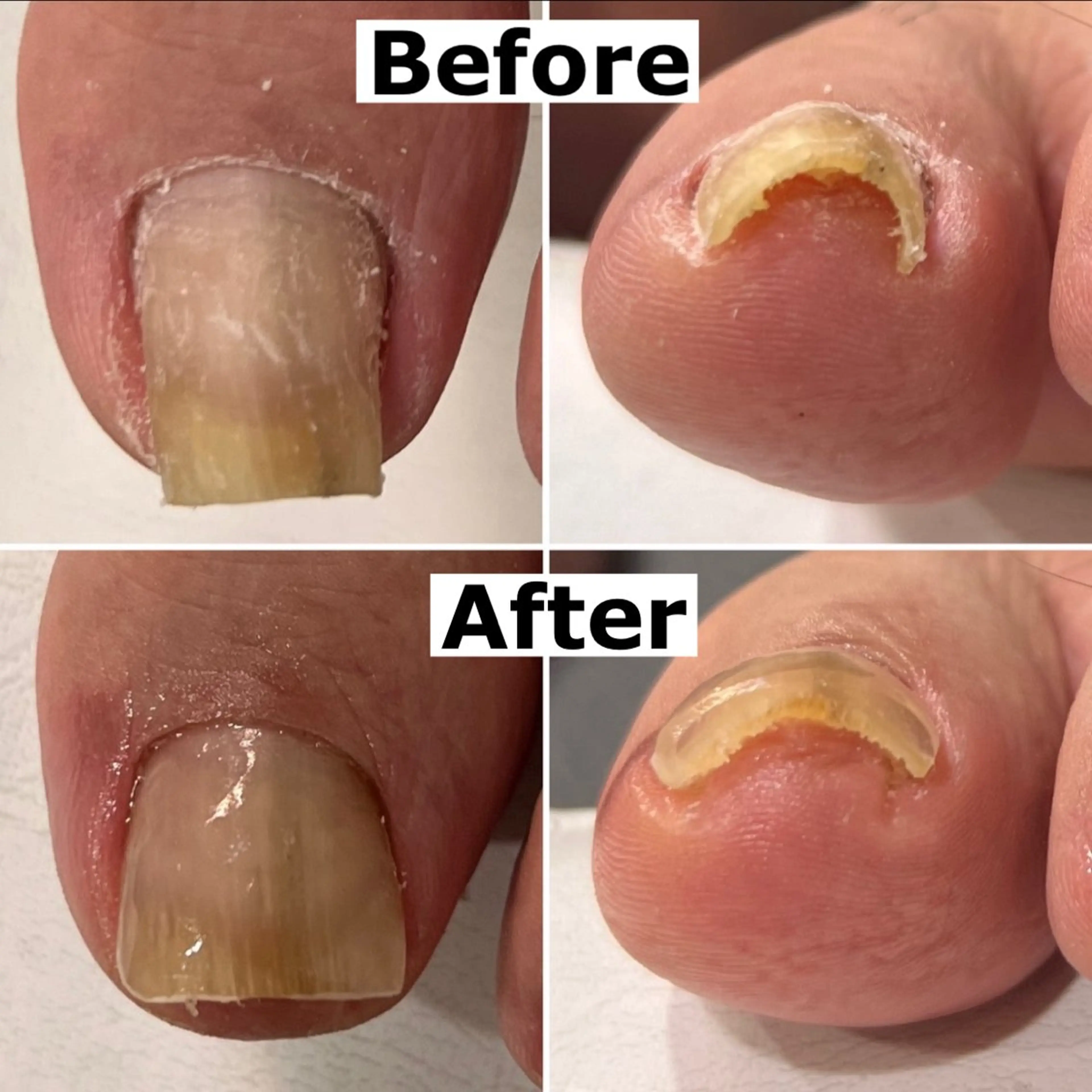 ネイル Mellow nail所属・巻爪無料モデル募集 ✨🦶MEGUMIのネイルデザイン