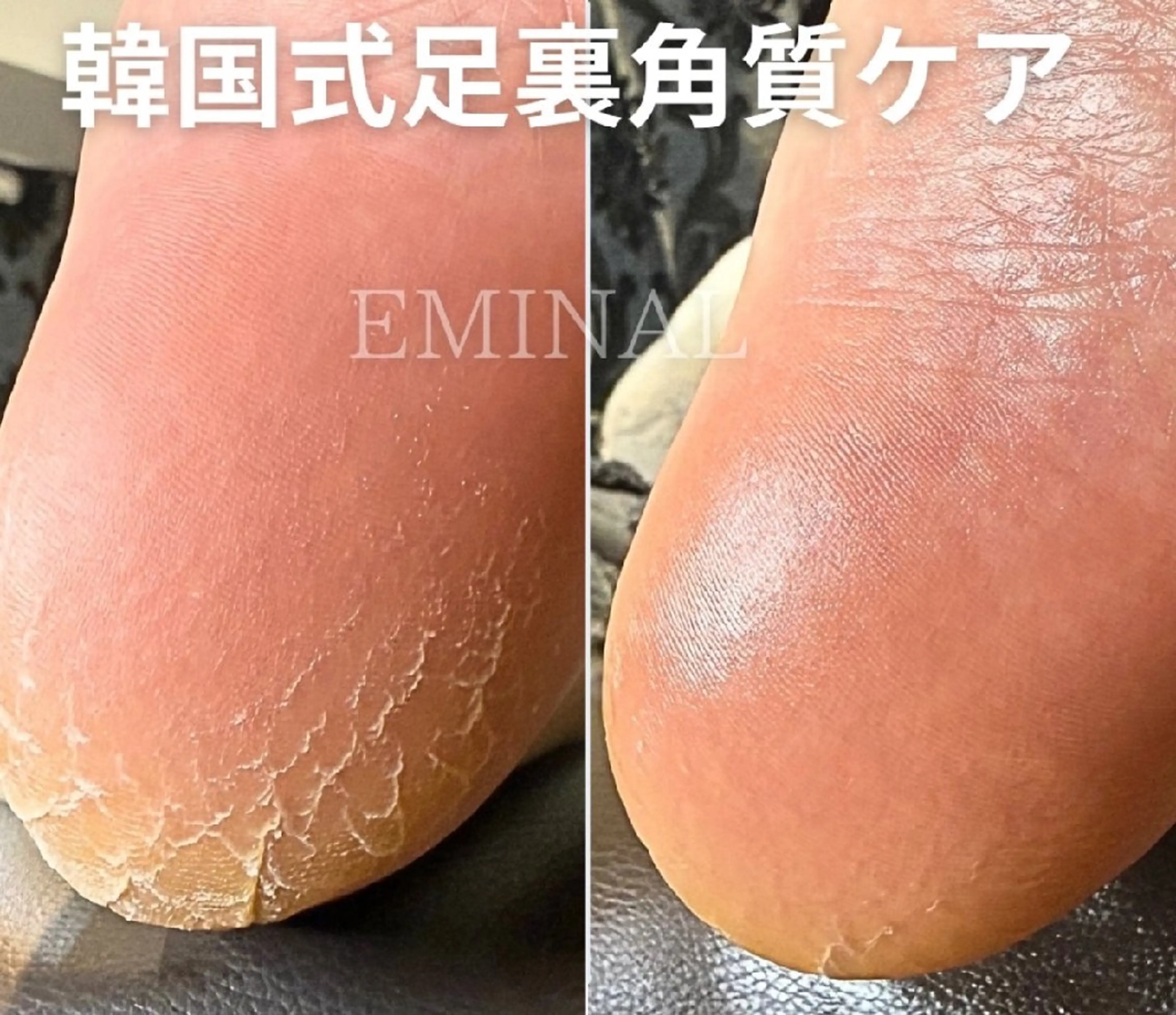 韓国式足裏角質ケアの写真
