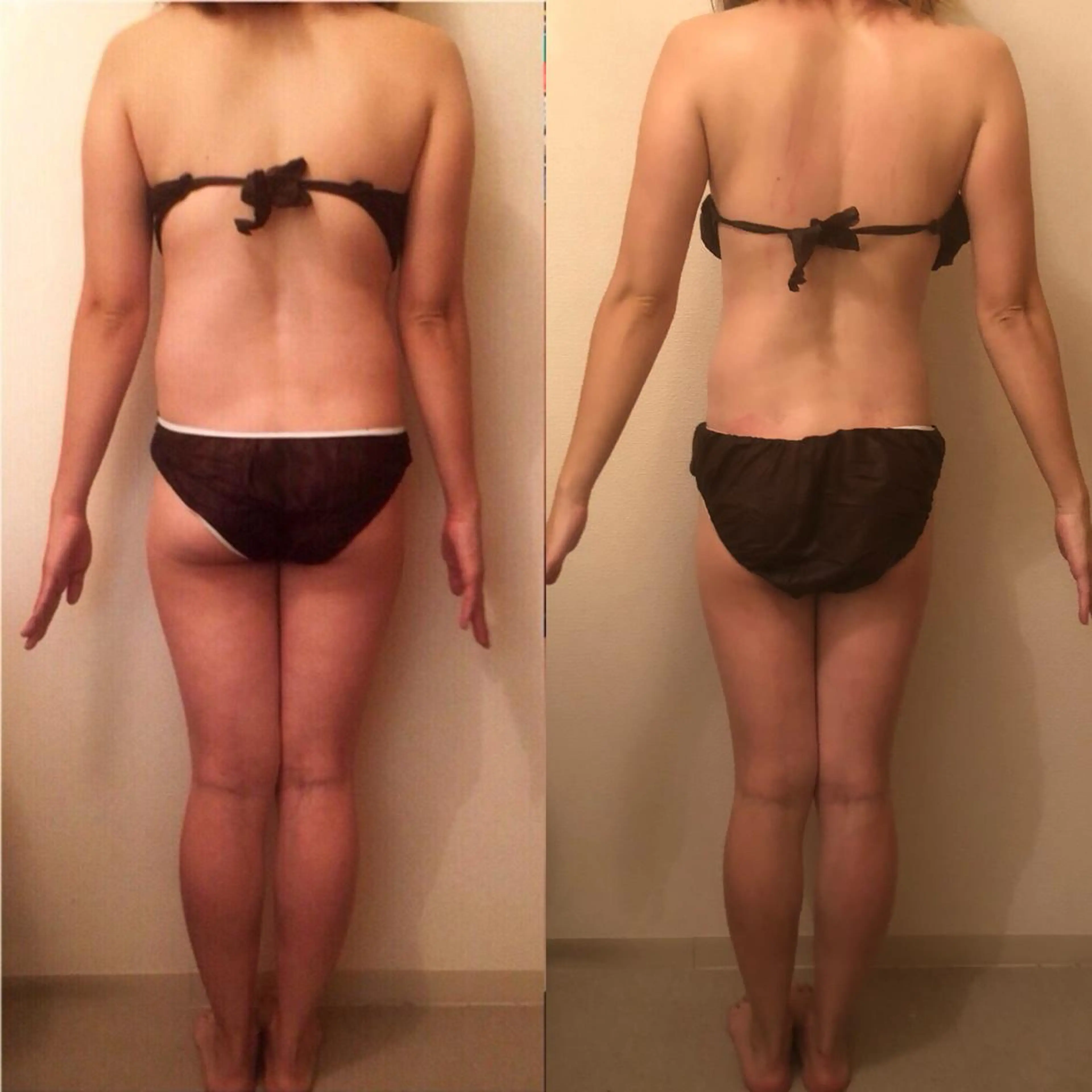 オーダーメイド痩身 部位集中の写真