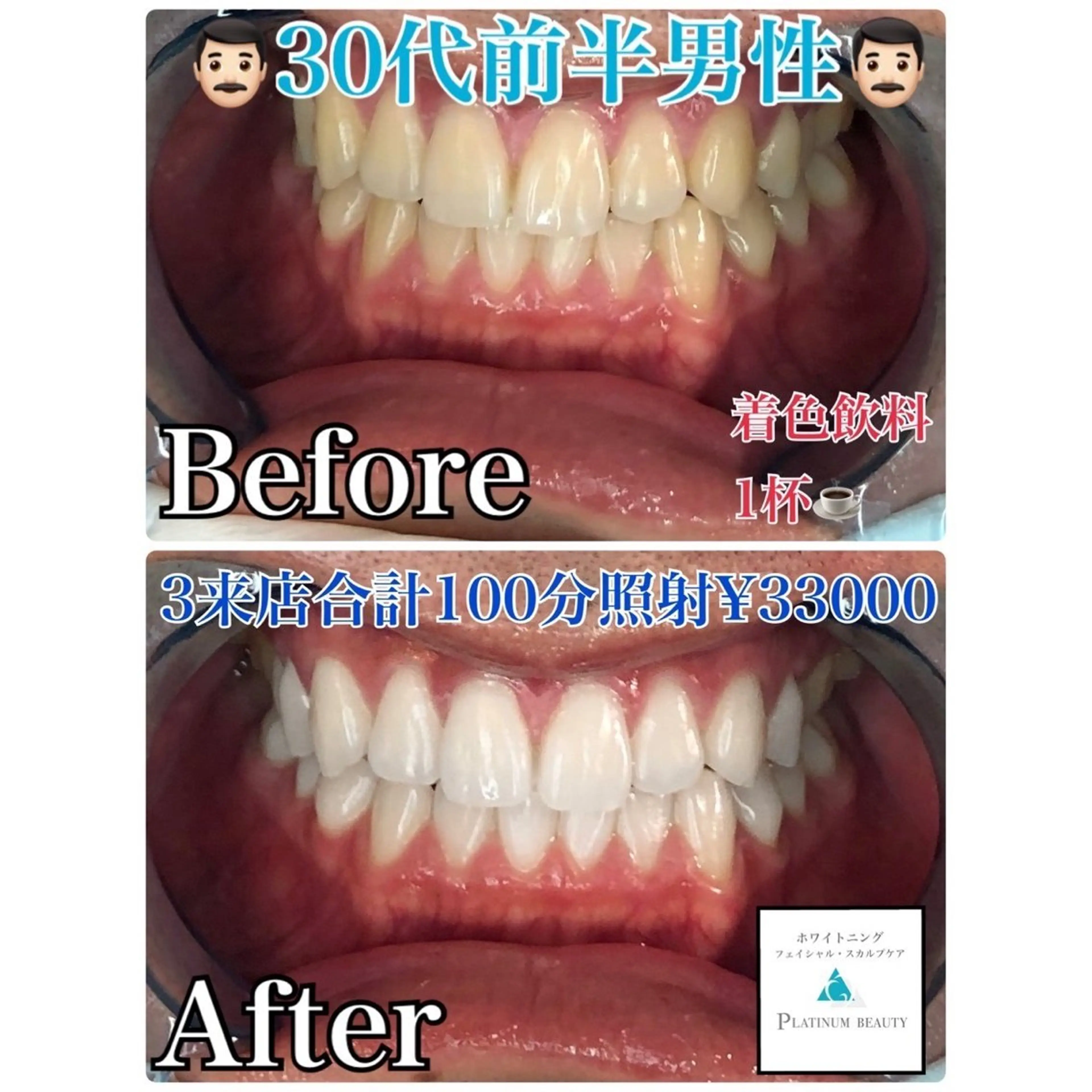 【着色を徹底的に落としたい方】初回セルフホワイトニング30分照射+100分照射  メンズ歓迎👨✨の写真