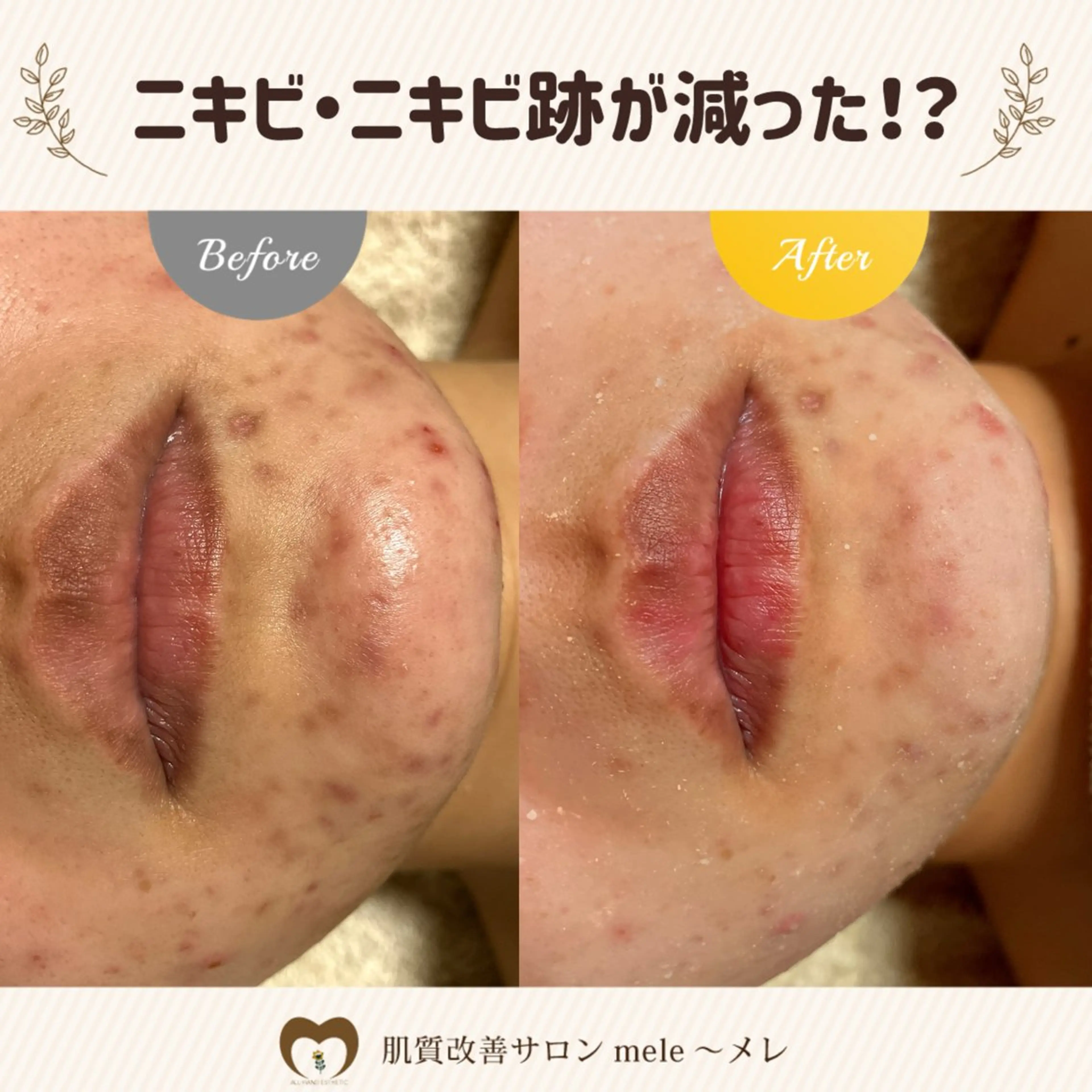 繰り返すニキビ・毛穴 ✨つくば肌質改善専門のエステ・リラクイメージ