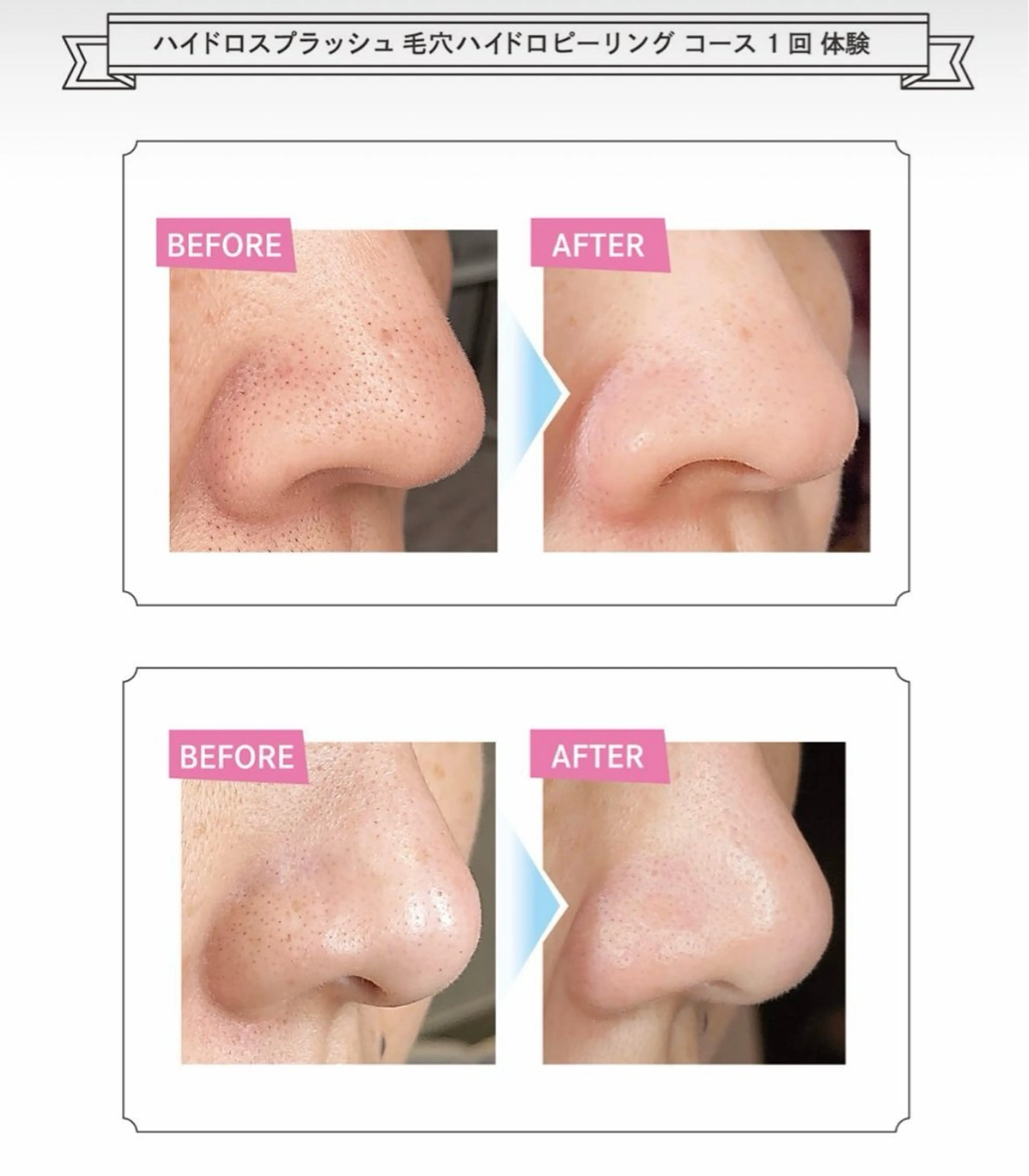 毛穴洗浄ハイドロスプラッシュの写真