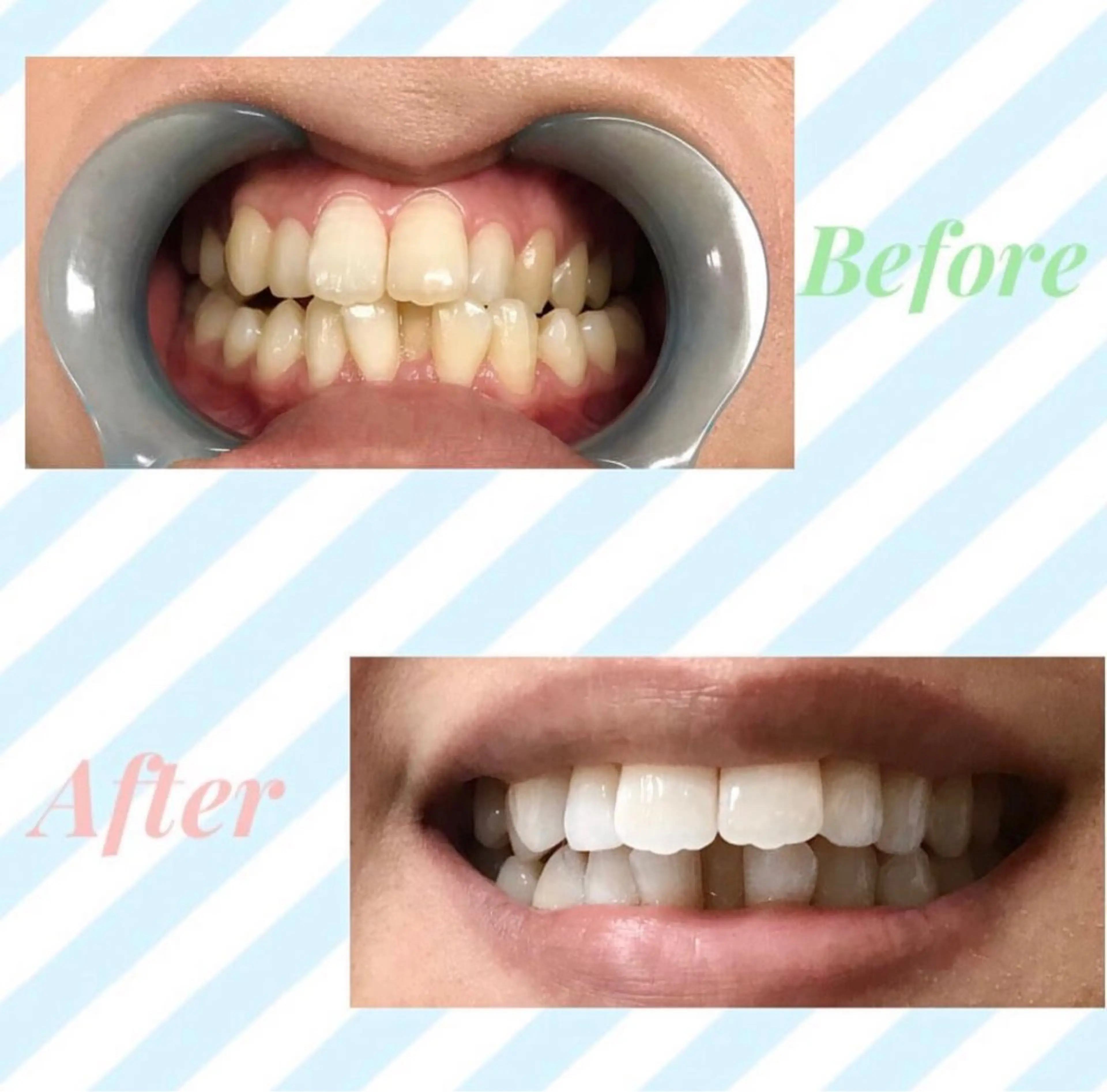 【ミニモ新規限定】メディアで話題✨セルフホワイトニング通常コース8分x2 【すぐ予約対象外】の写真