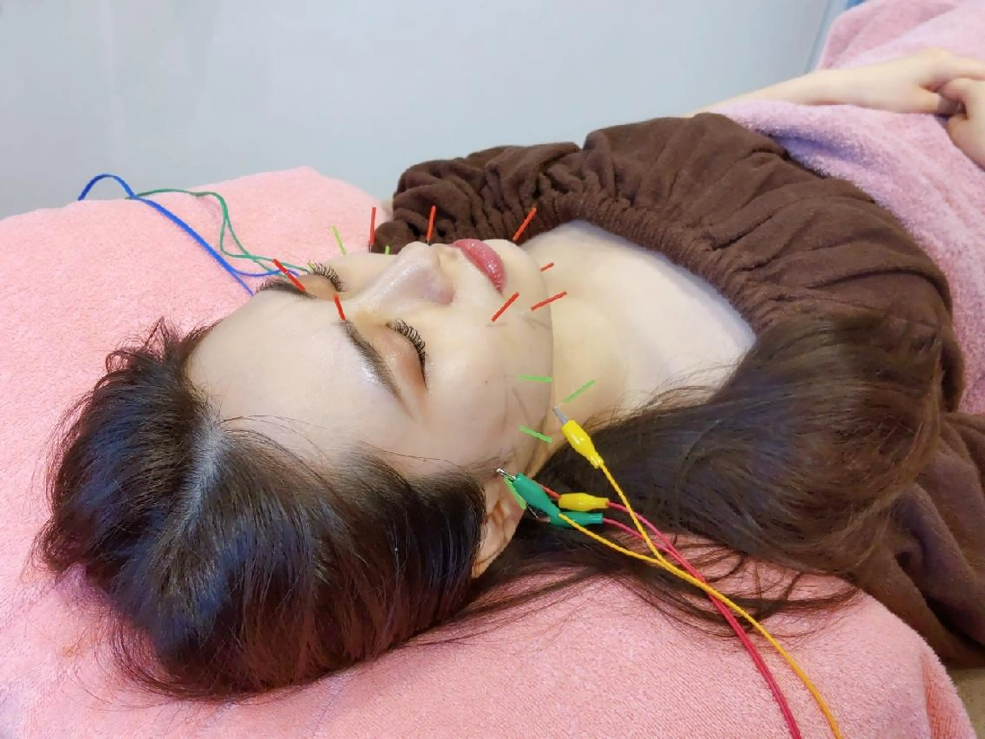 土日祝❤リピーター割❤『小顔ケア美鍼』リフトアップ美容鍼＋小顔電流✨の写真