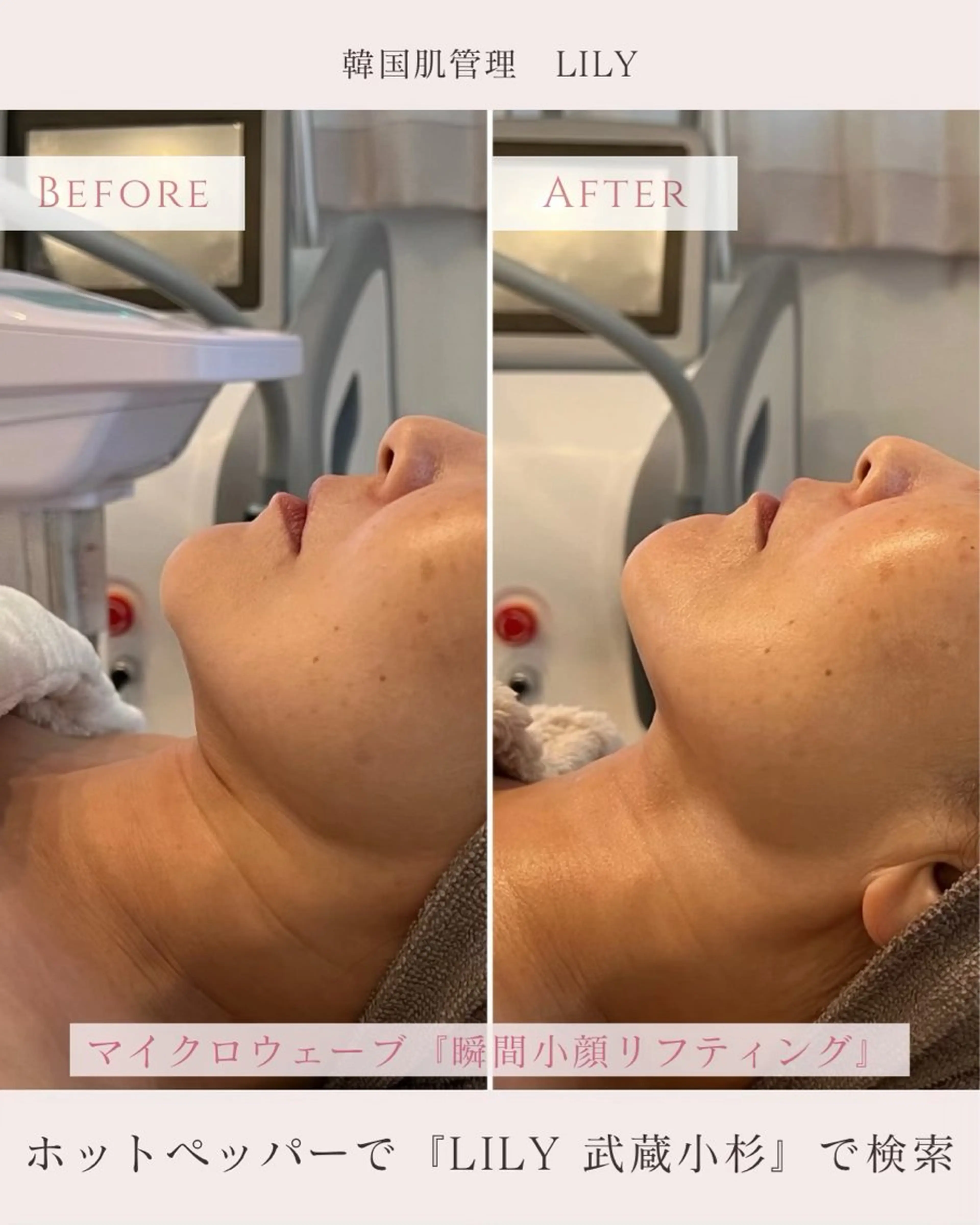 大人気！エステ版オンダリフト×AHAハーブピーリング　¥36000→の写真
