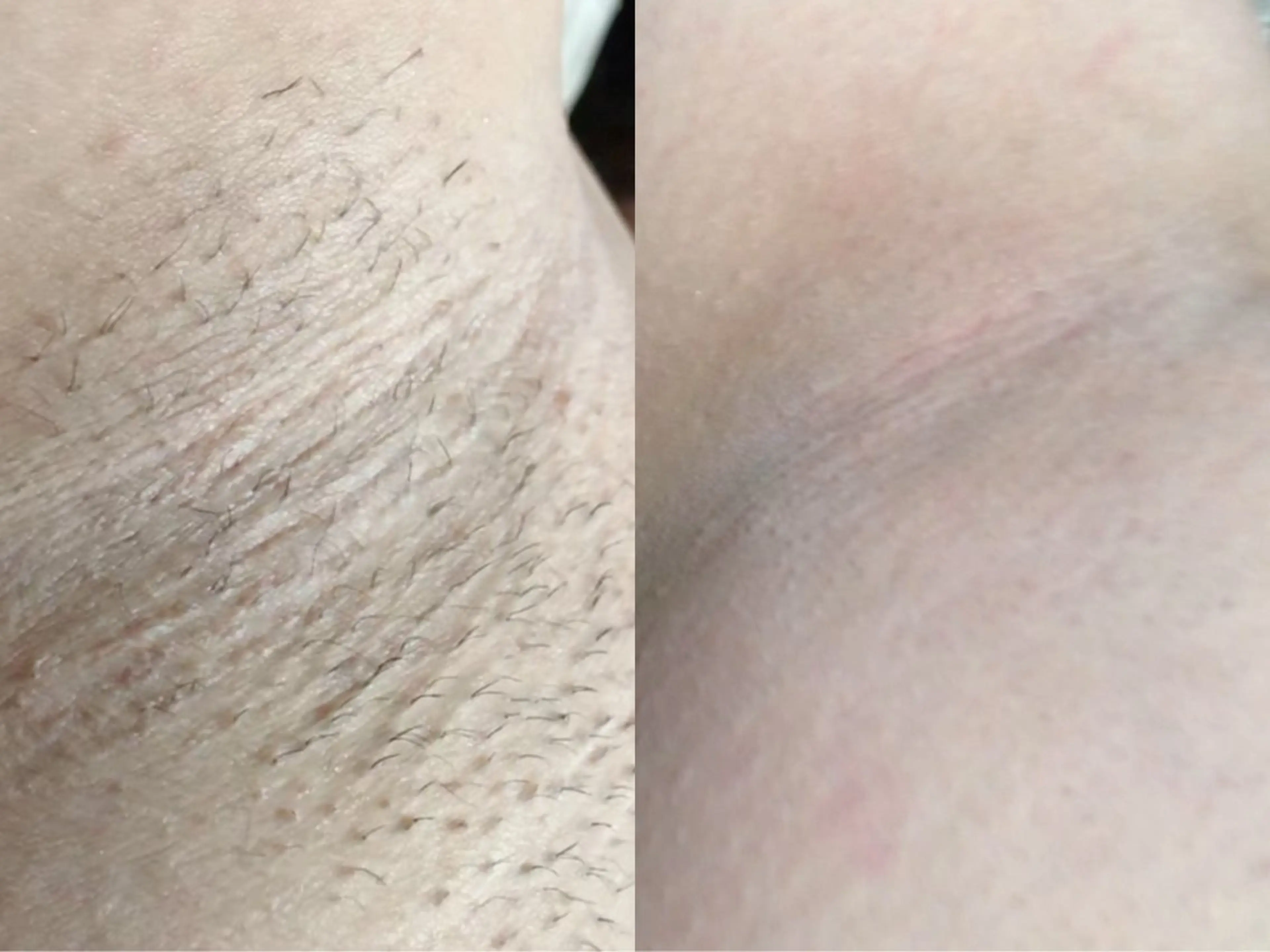 脱毛 Hitomi シュガーリング豊橋のその他イメージ