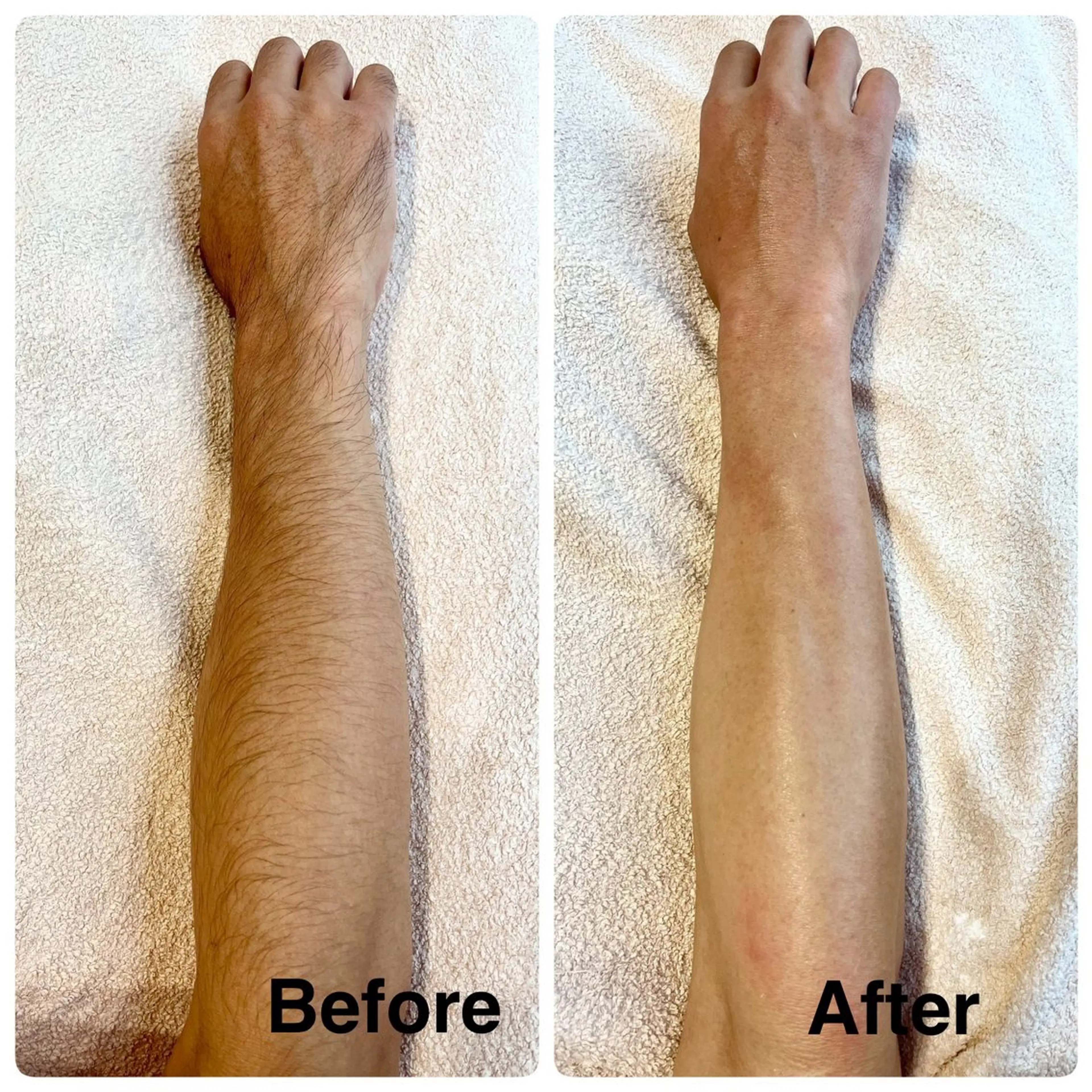 【美肌シュガーリング】ひじ下 脱毛の写真