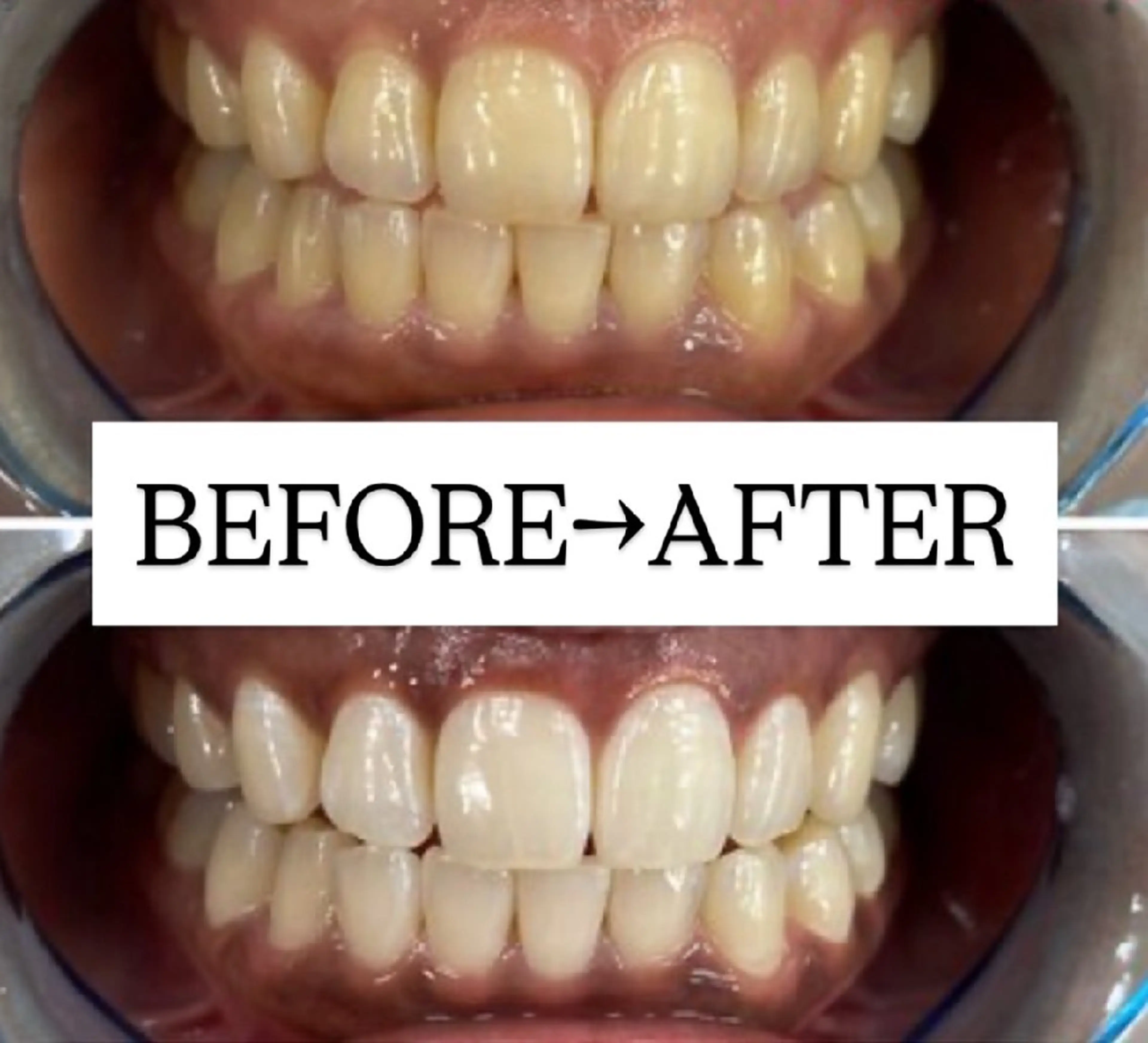 【歯科提携】歯のセルフホワイトニング専門店 セルフホワイトニングサロン宝塚所属・箕浦 乙葉のその他イメージ