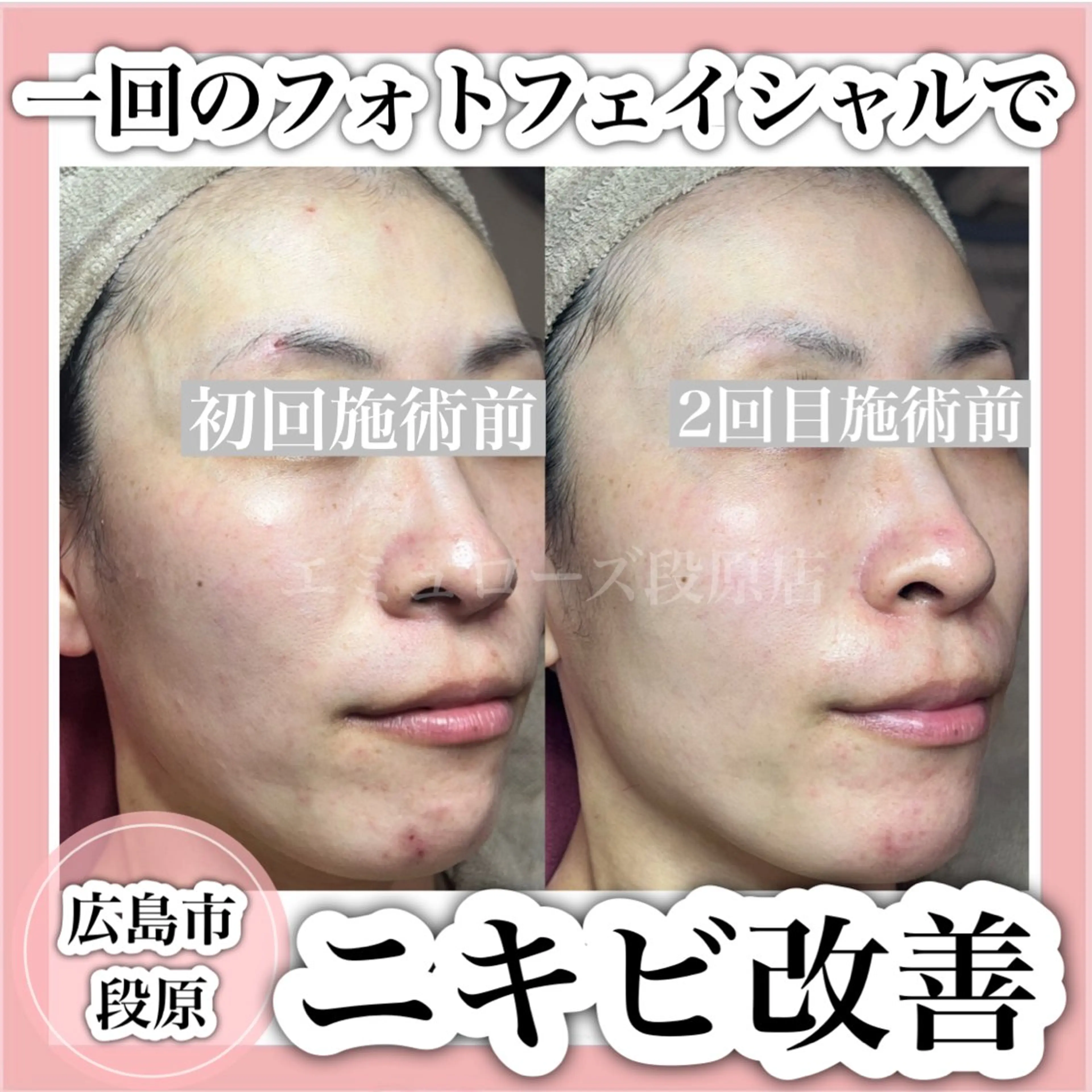 《凸凹肌・毛穴の開き・ニキビケアでお悩みの方》光フェイシャルの写真