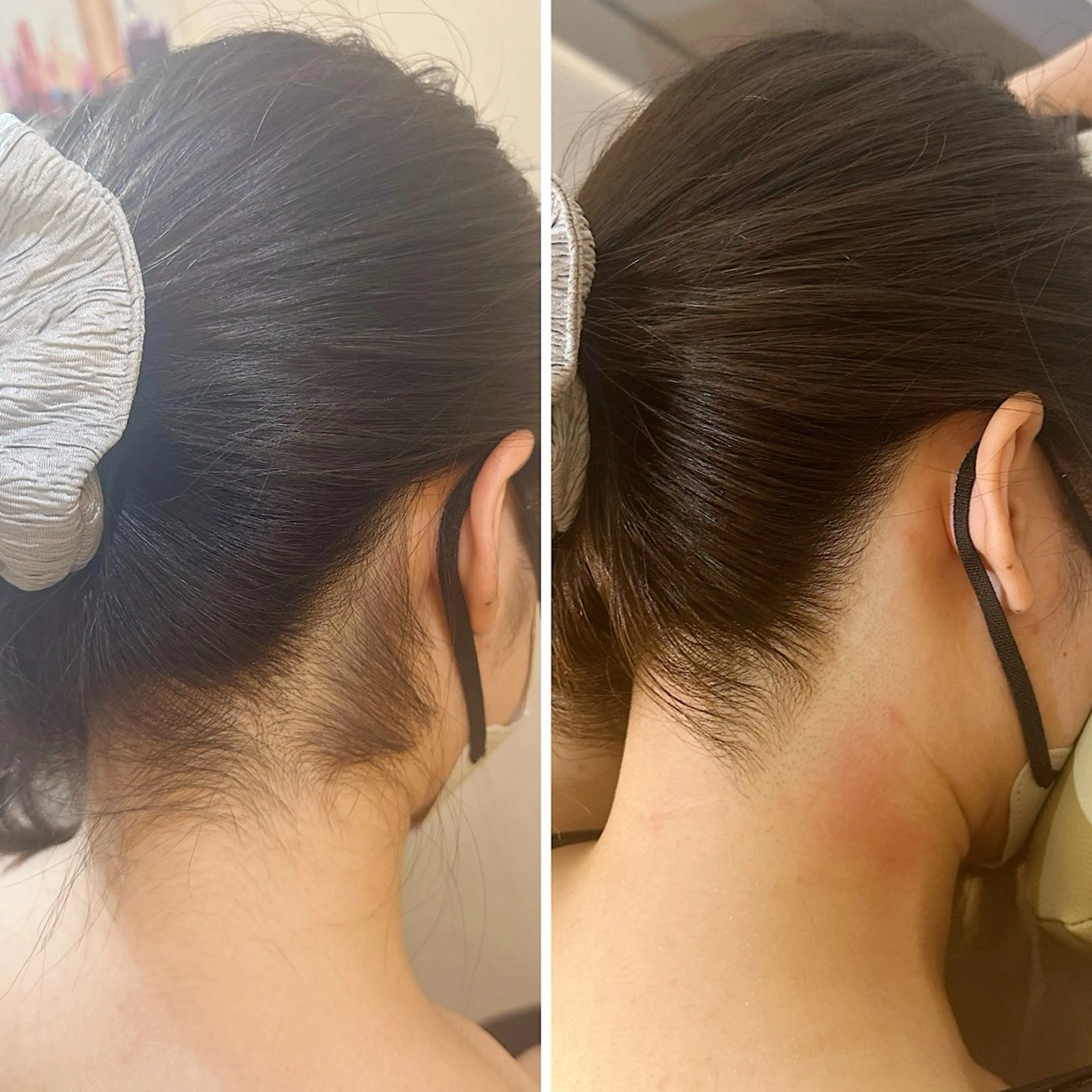 脱毛 うなじ脱毛/美肌脱毛 LABELのエステ・リラクイメージ