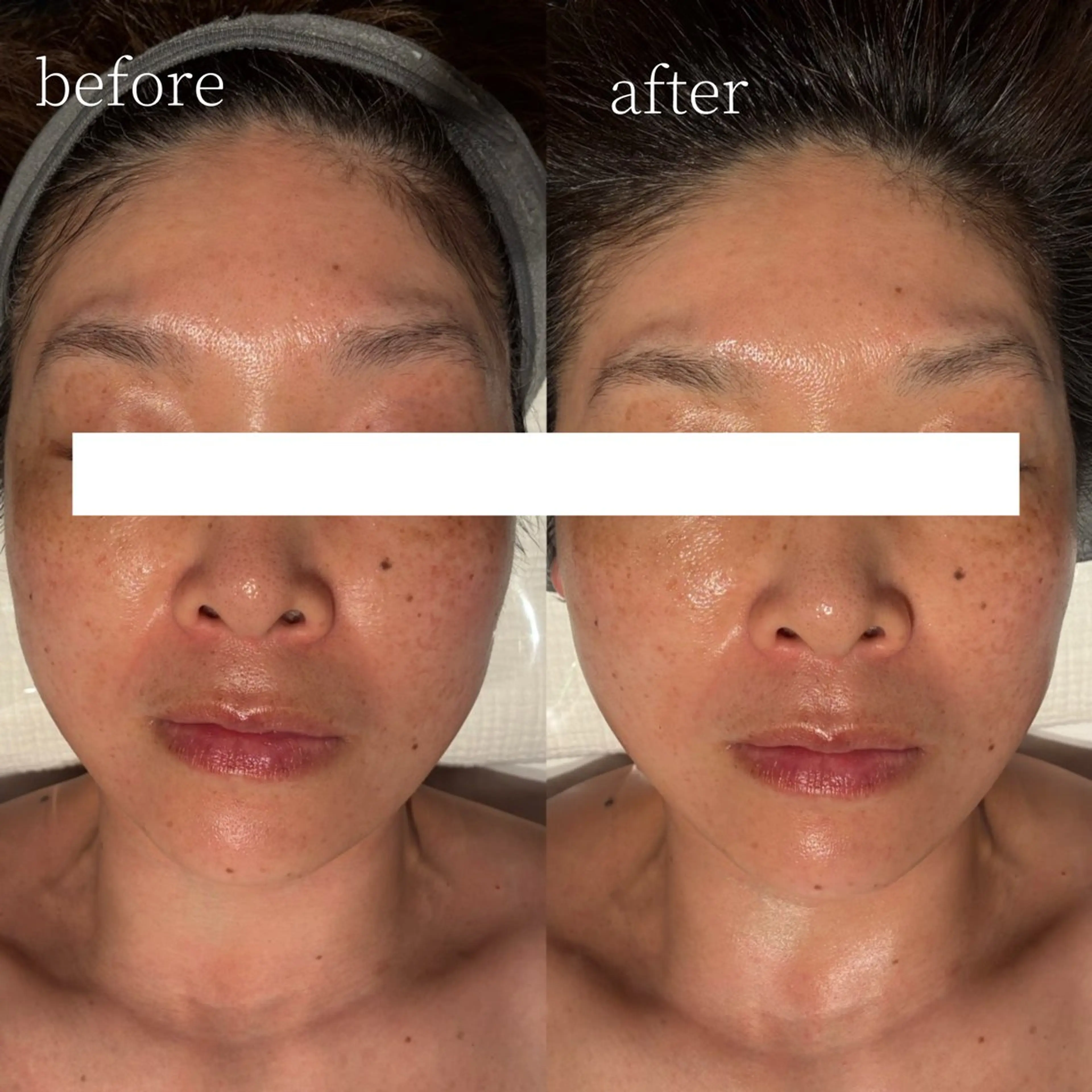 脱毛 Erika komorebi_のエステ・リラクイメージ