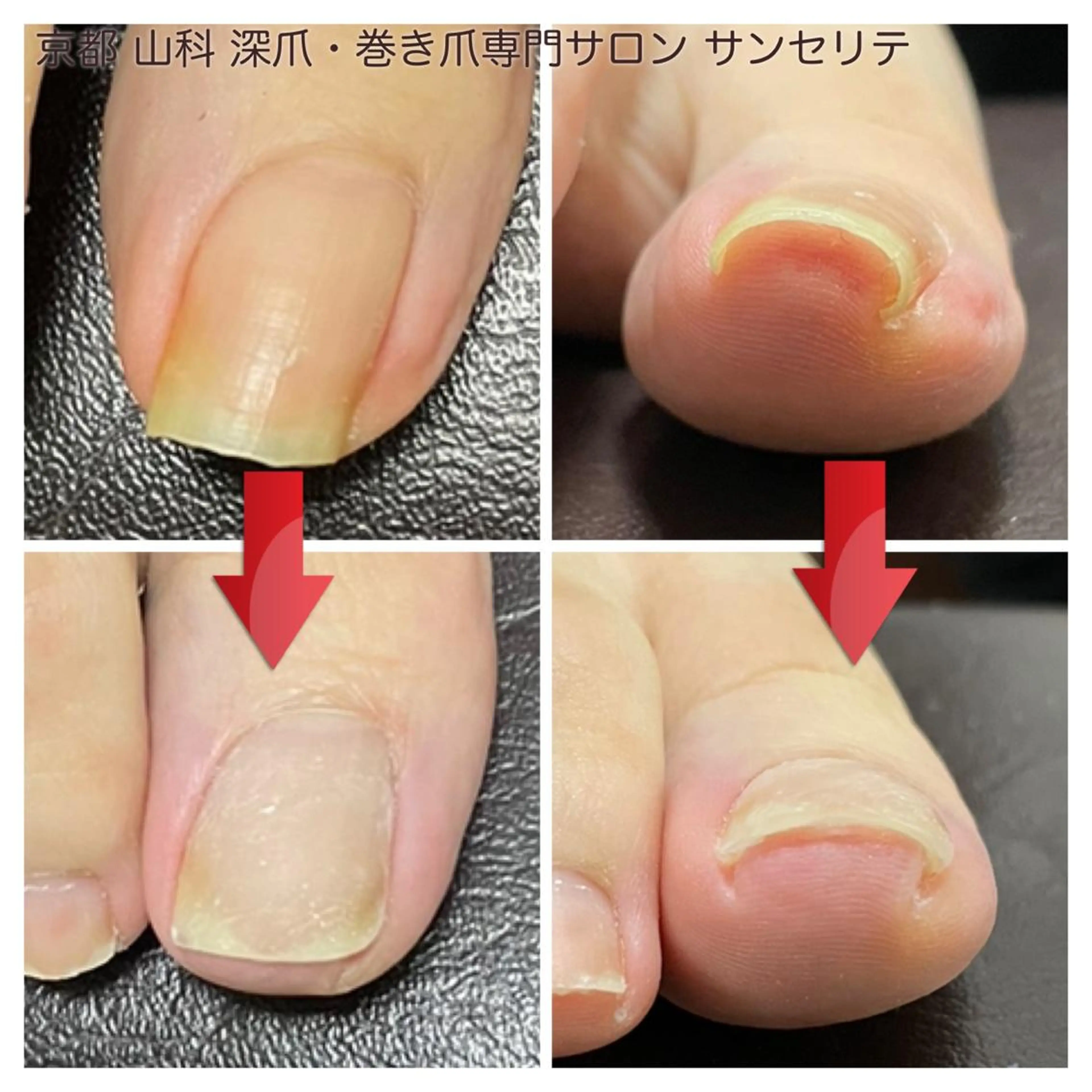 巻き爪補正(親指1本) ※別途トラブル用オイル3800円の写真