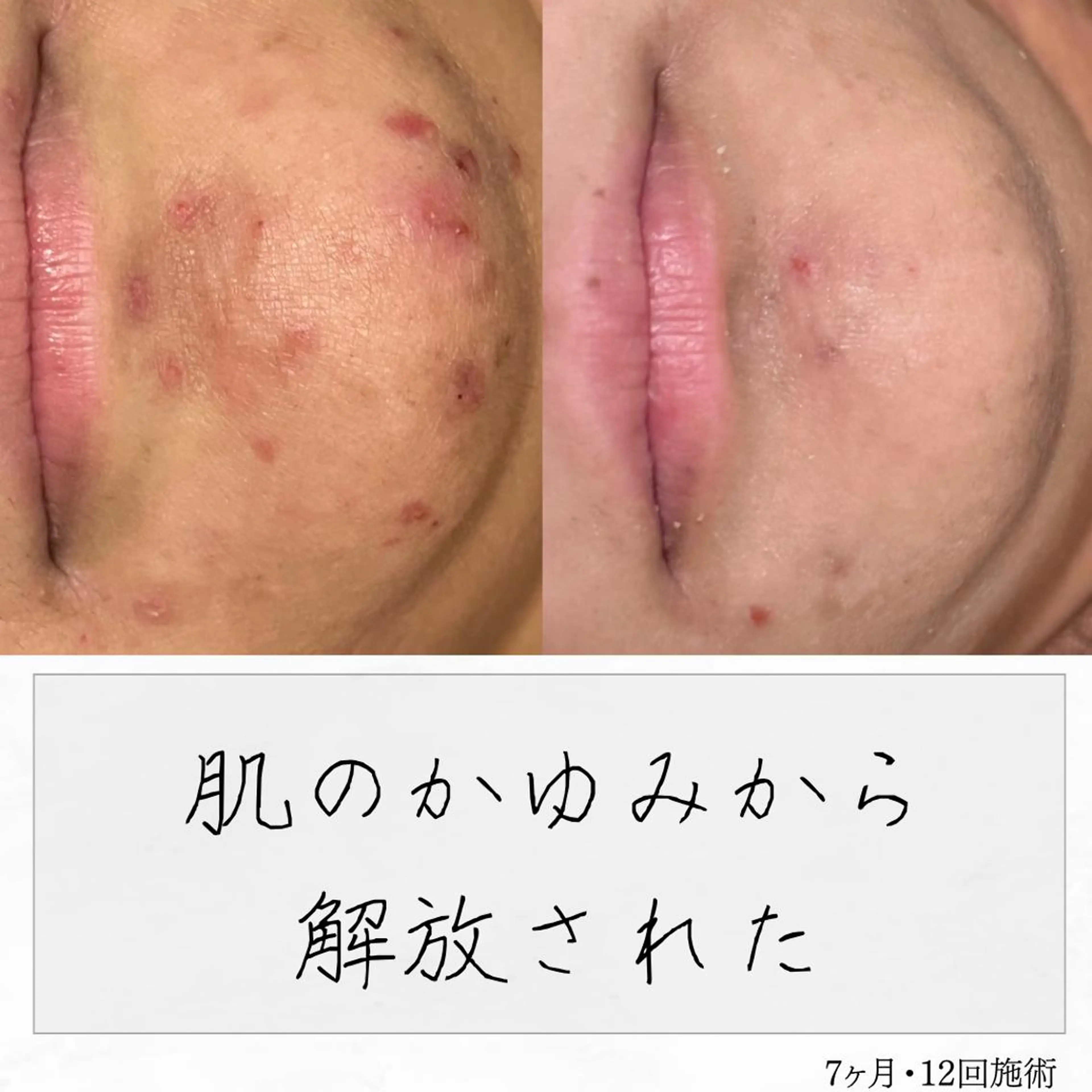 ニキビ経験者が施術 する専門サロン🌻のエステ・リラクイメージ