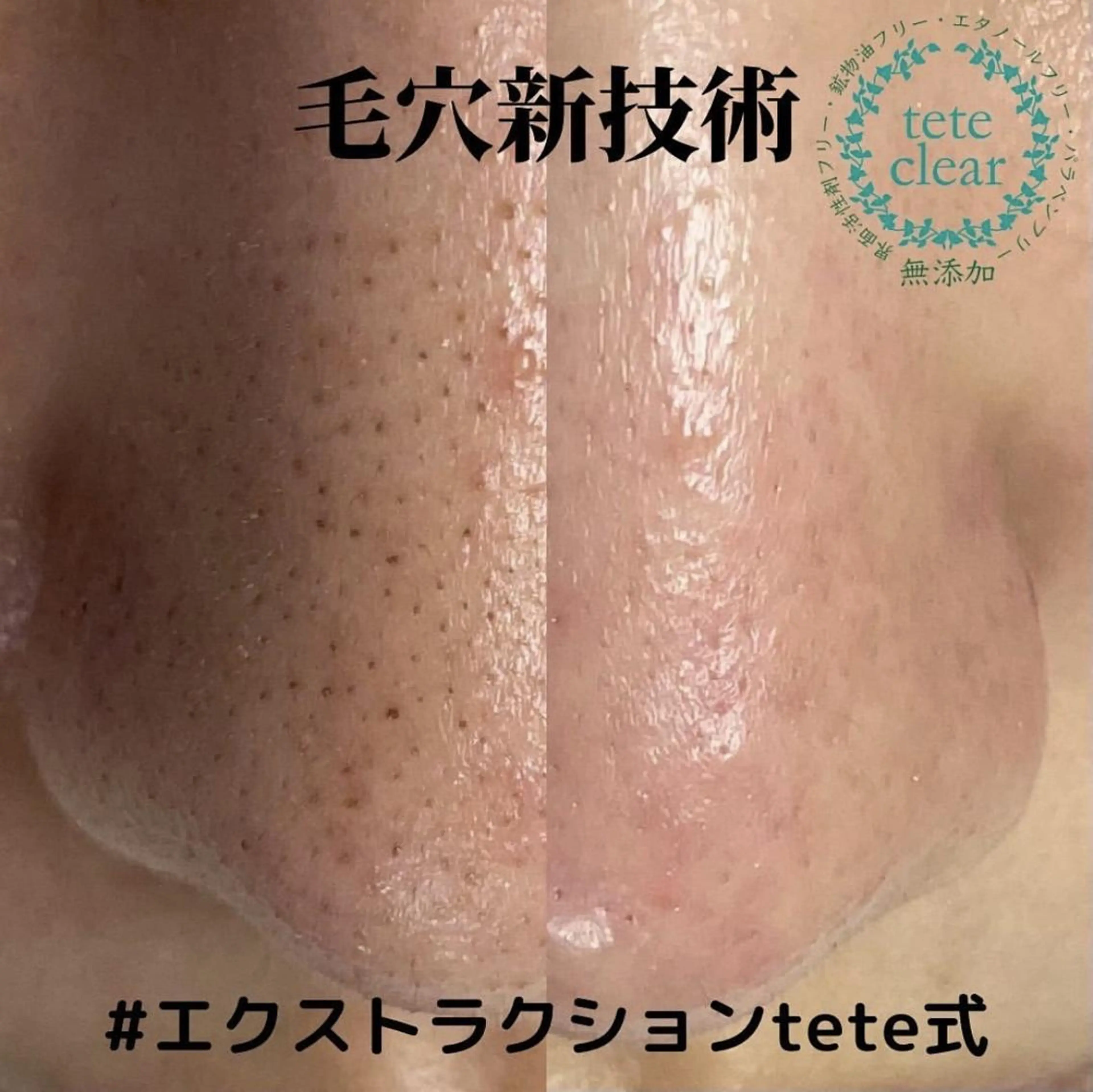 思わず触りたくなるほどピカピカに★まるごと全顔エクストラクション＋光脱毛の写真