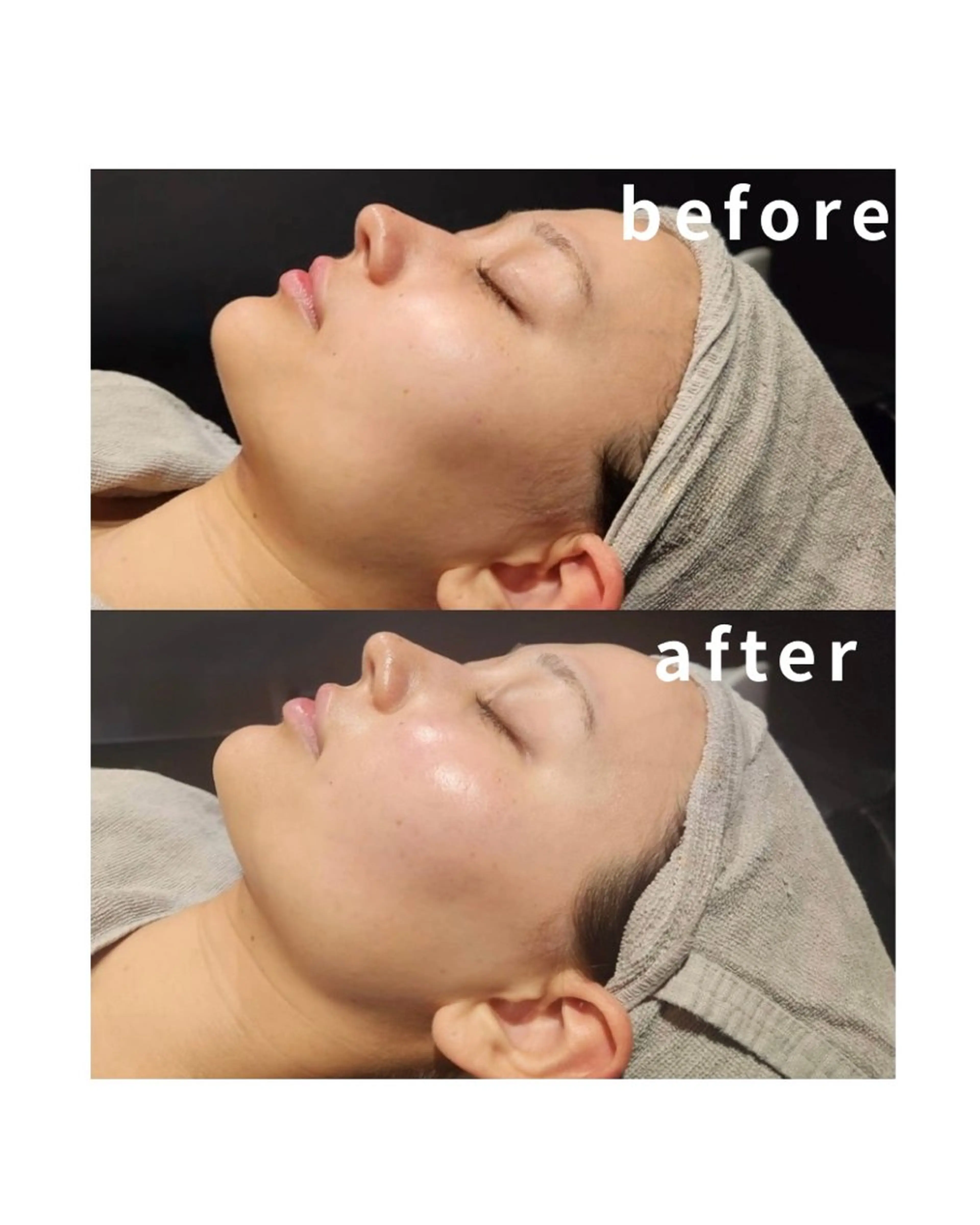 【スペシャルシェービング】クレンジング＋顔シェービング（眉込み）＋リフトアップマッサージ＋小鼻毛穴吸引＋酵素パックの写真