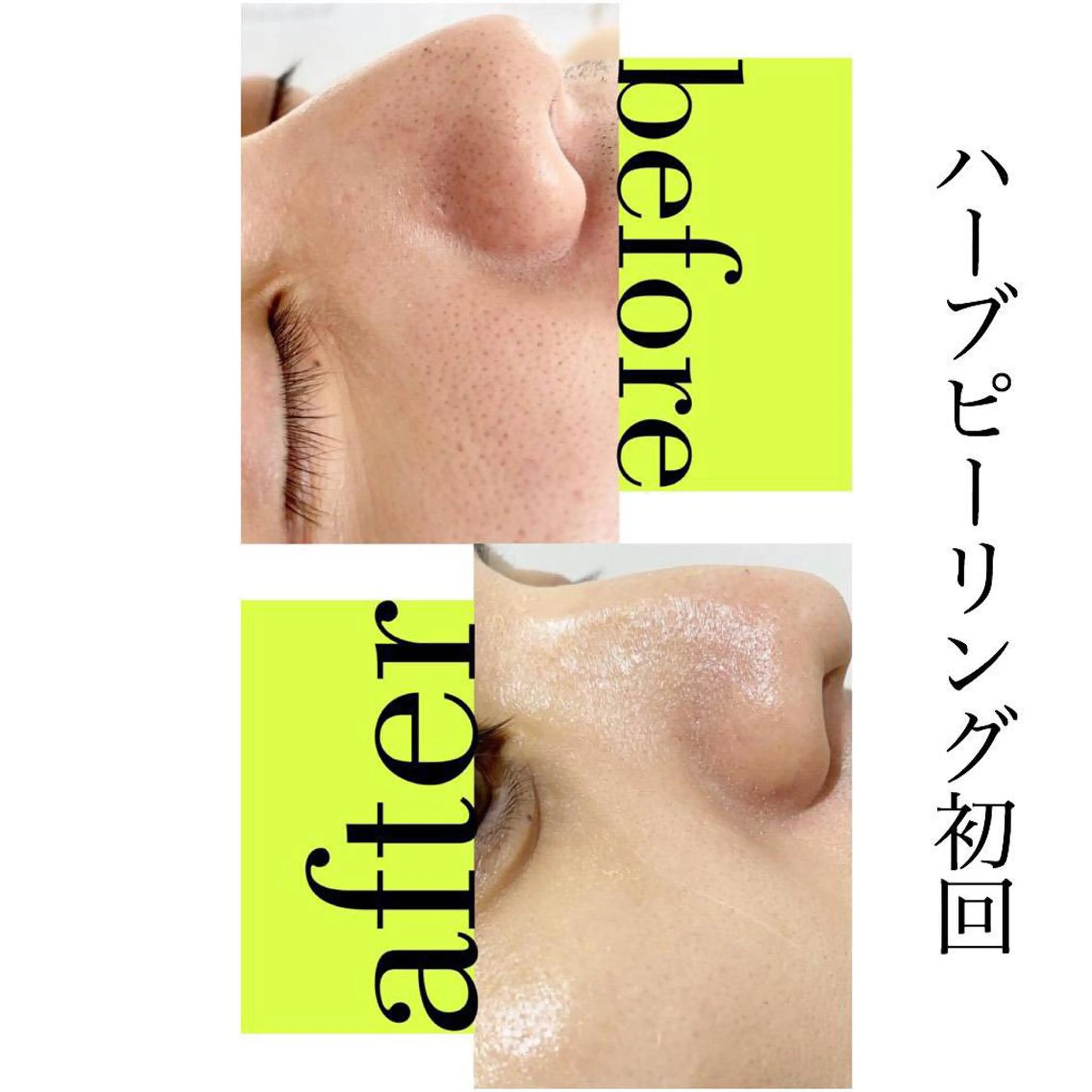 【新規限定】【剥離あり】ハーブピーリング(レベル7) 60分 通常料金28,000円の写真