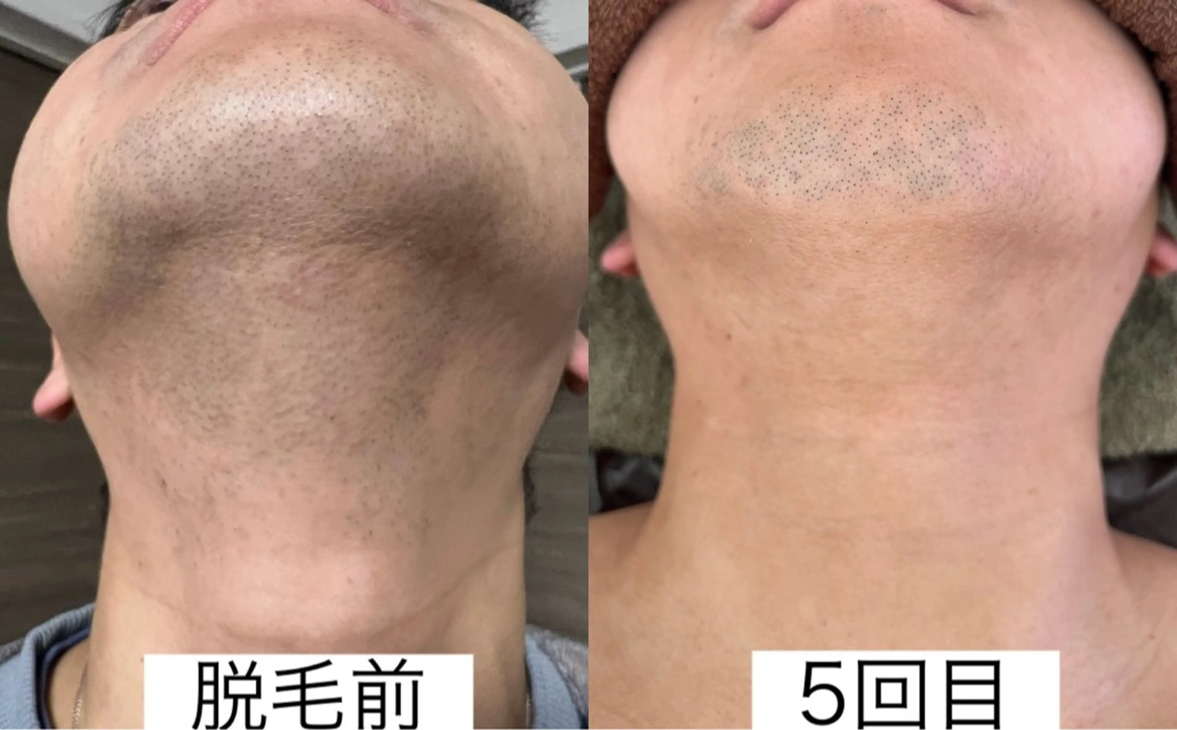 【ミニモだけの特別価格】メンズヒゲ脱毛の写真