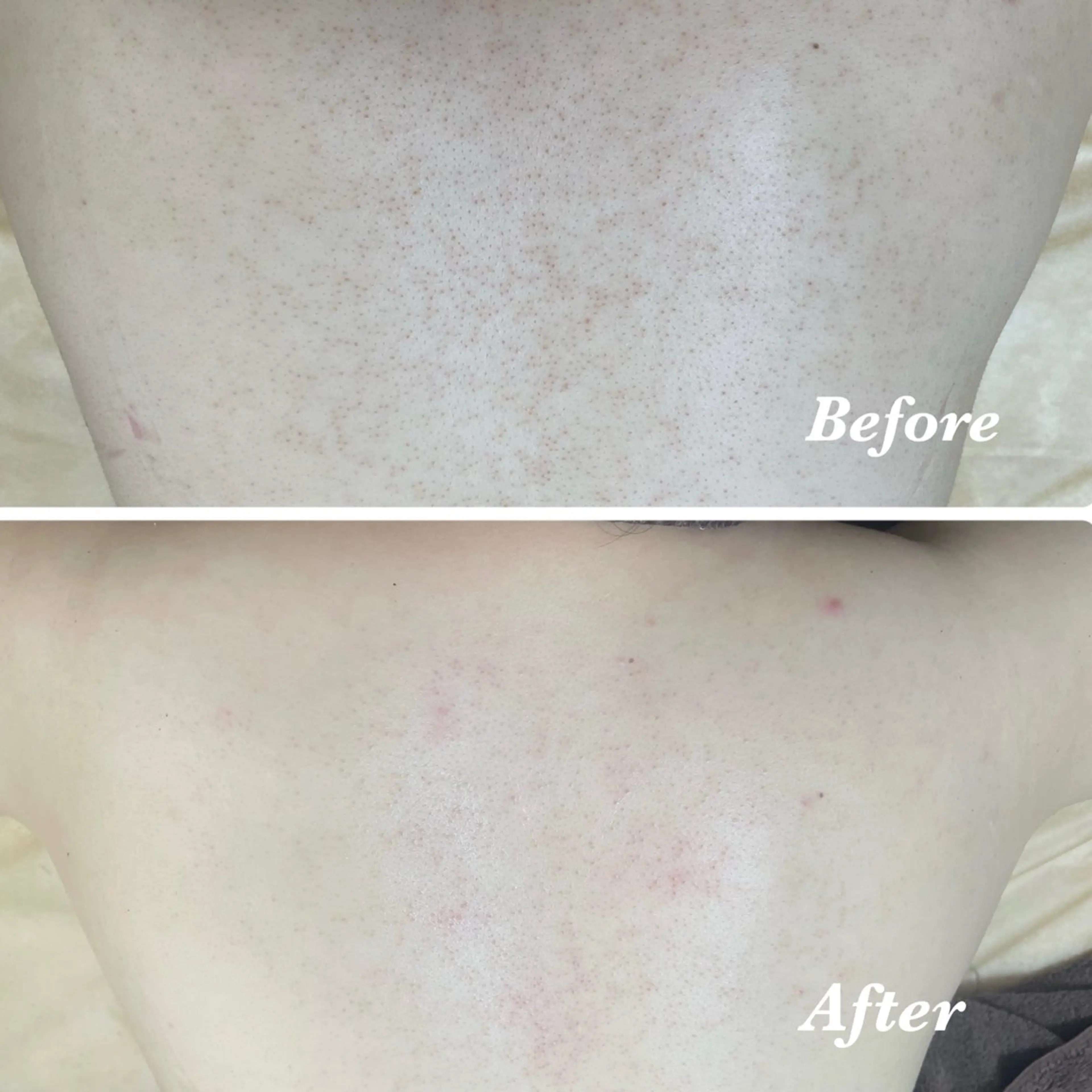 背中上部 👙 REVIハーブピーリング《陶肌トリートメント》 / 背中上部の肌荒れに。肩周りもスッキリ！の写真