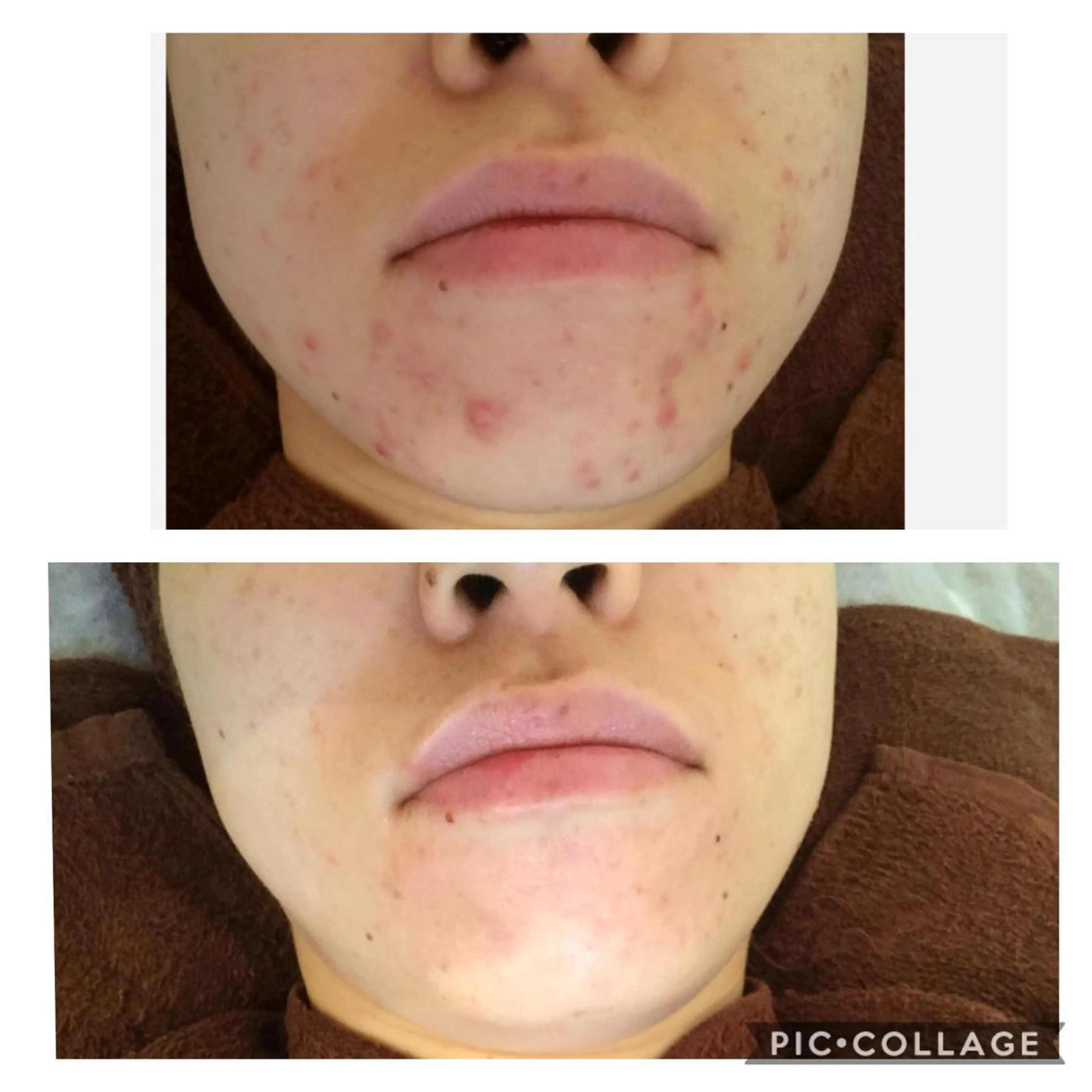 エステ リラク ニキビ/肌質改善専門 Snow skinのエステ・リラクイメージ