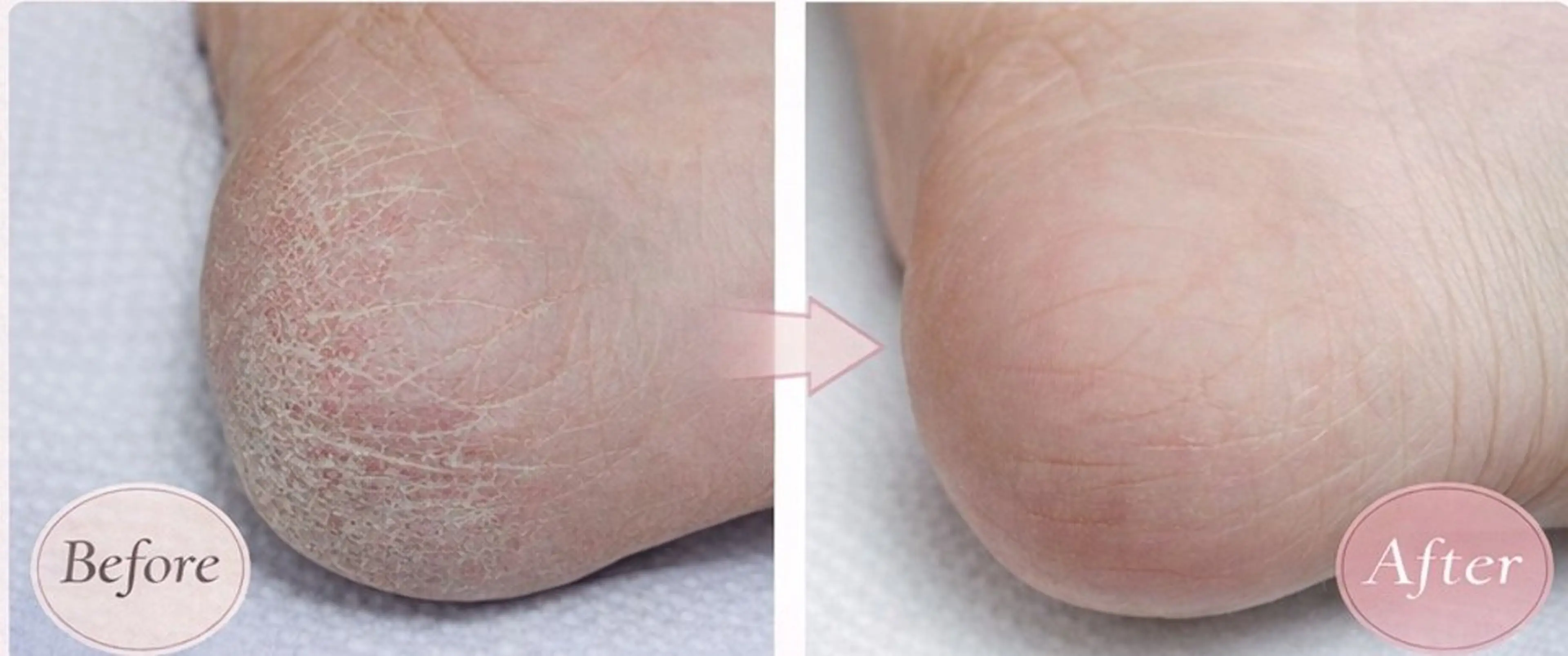 角質ケアの写真