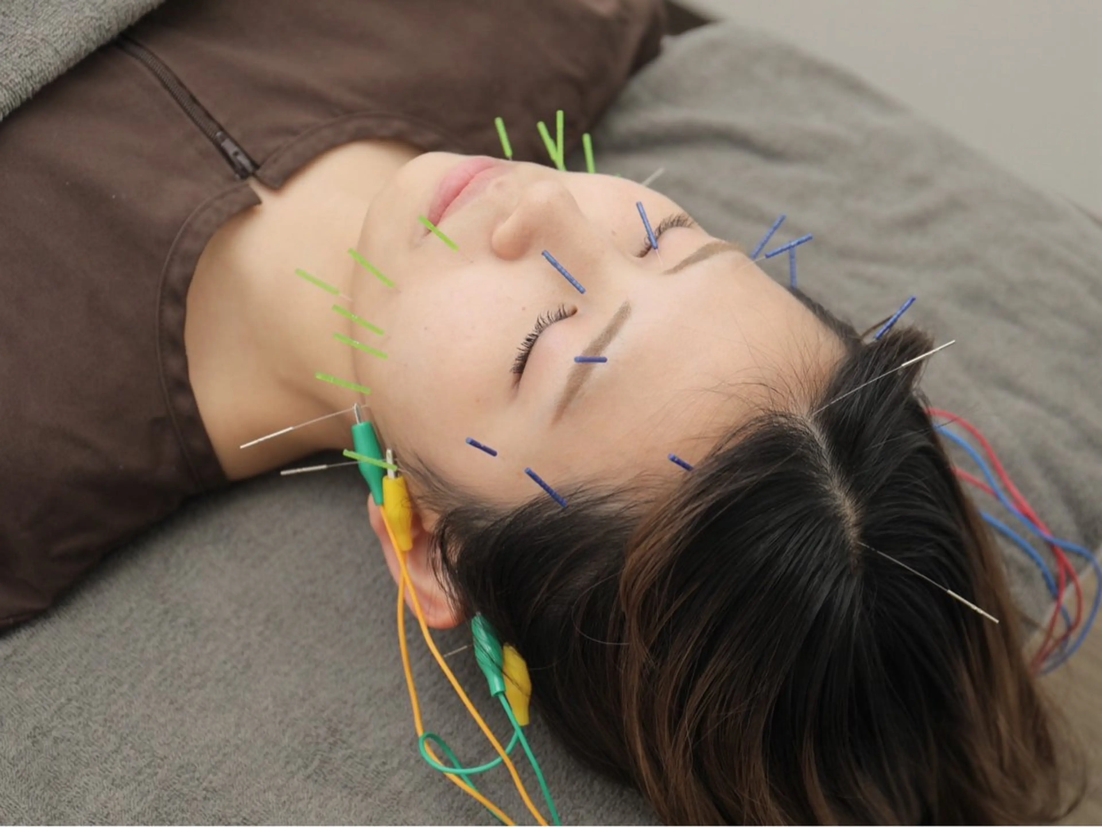 口コミ&写真撮影📷にご協力いただける方🙇‍♀️ 美容鍼　（45分）　💄メイクオフ不要の写真