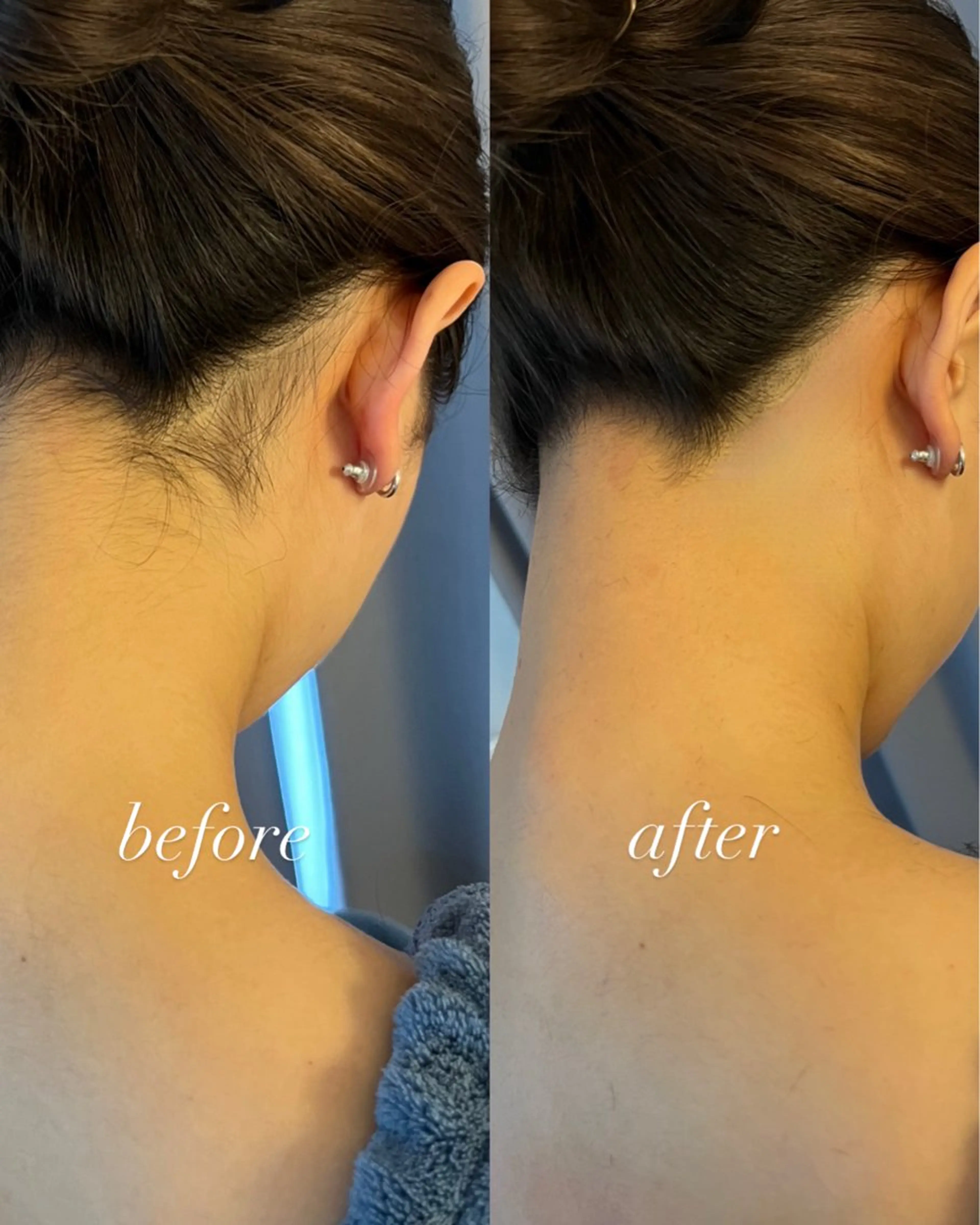 脱毛 うなじ脱毛/美肌脱毛 LABELのエステ・リラクイメージ