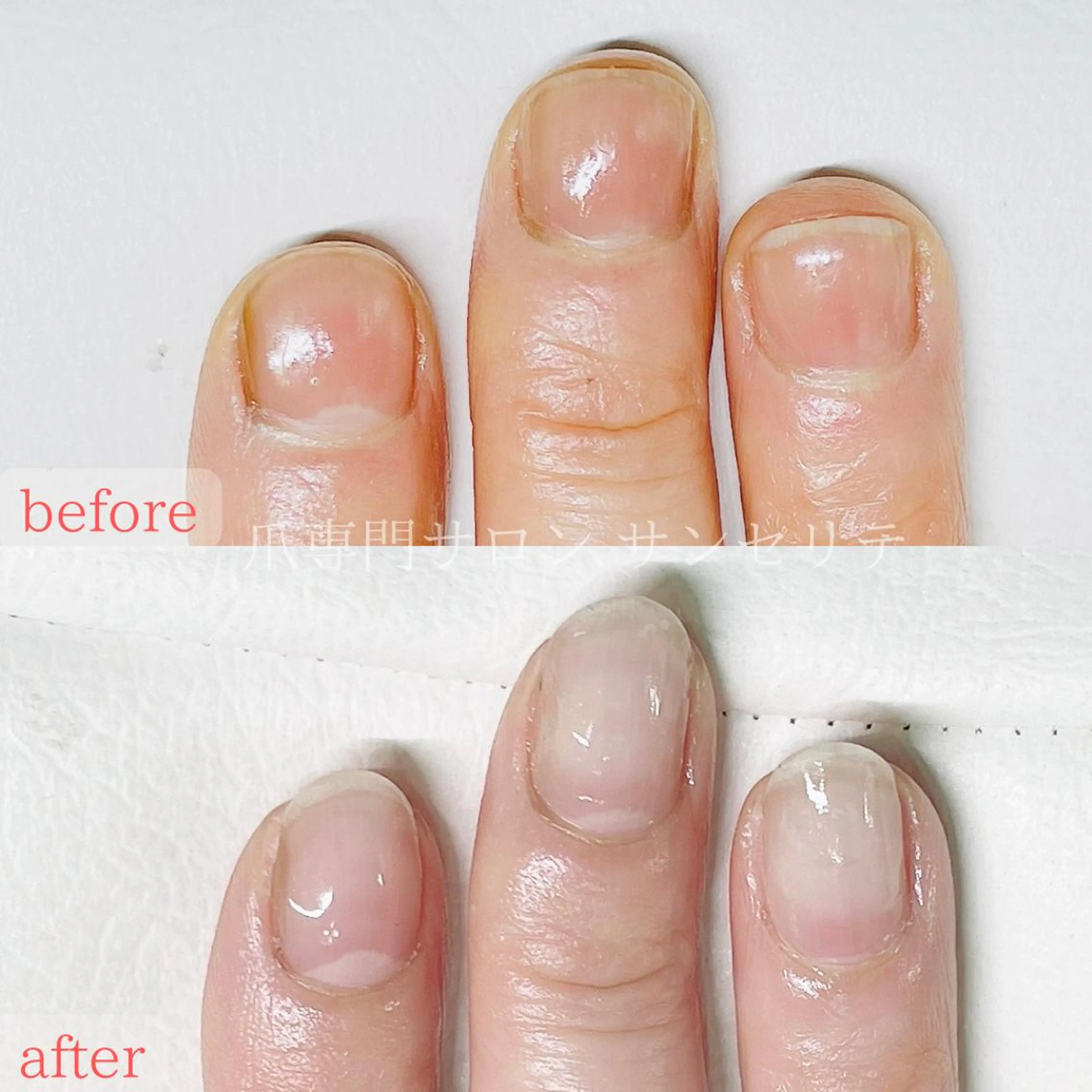 ネイル 深爪・巻き爪 専門サンセリテのネイルデザイン