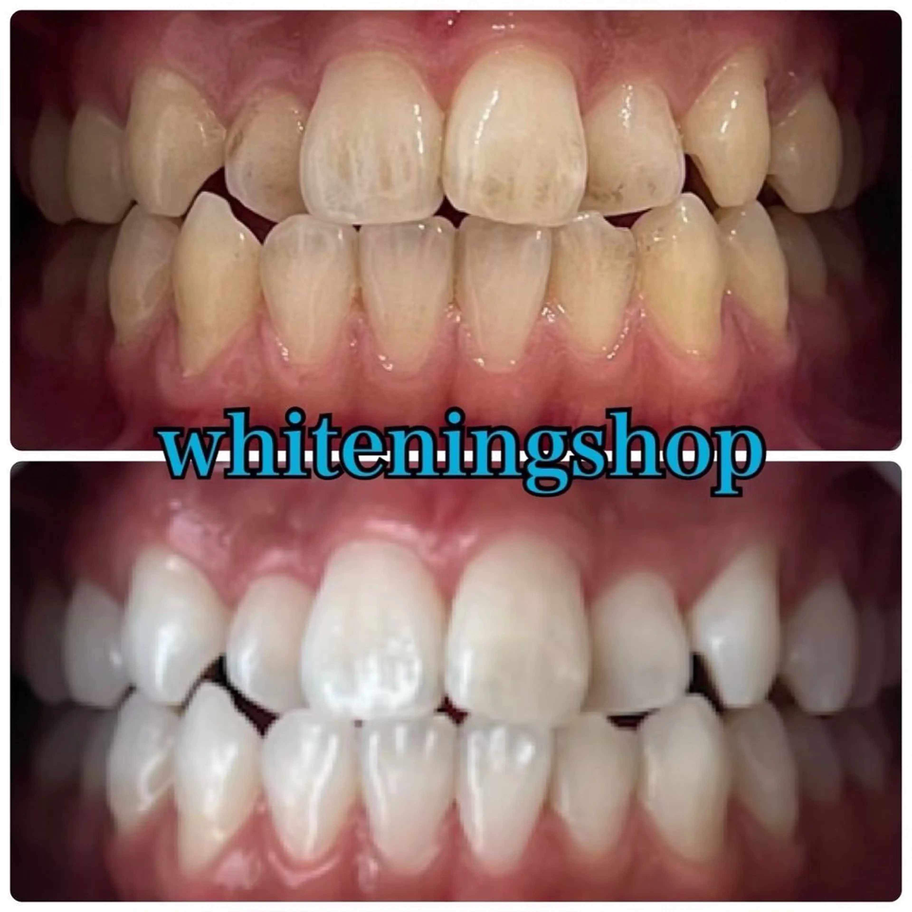 【本日予約限定✨️】美白セルフホワイトニング💗たっぷり40分照射☆¥7,980⇒¥1,980♪の写真