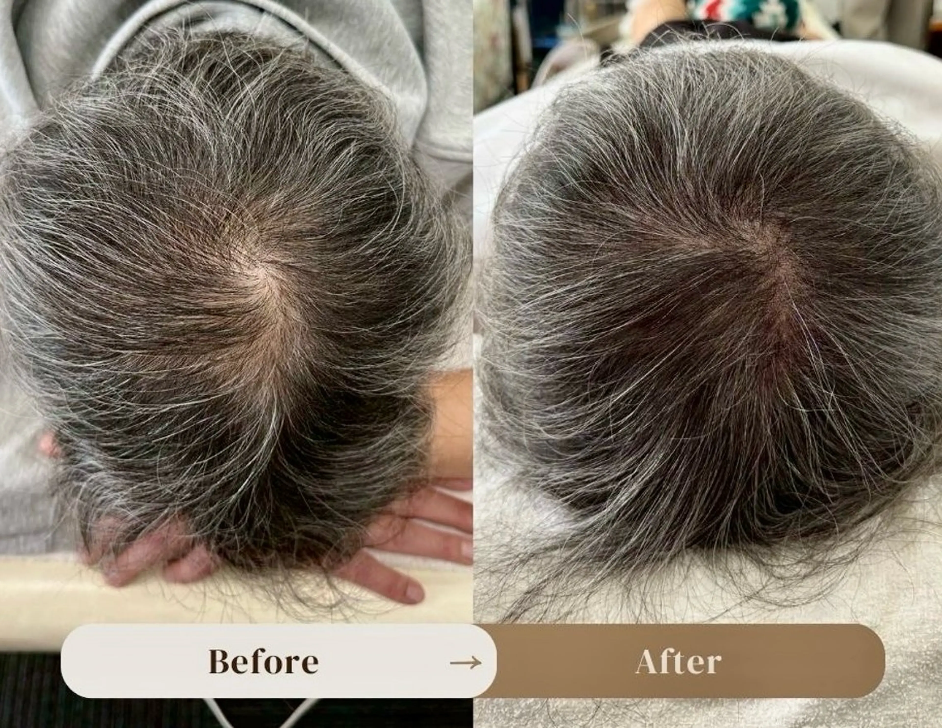 つむじのお悩み解消ヘアタトゥー（SMP）の写真