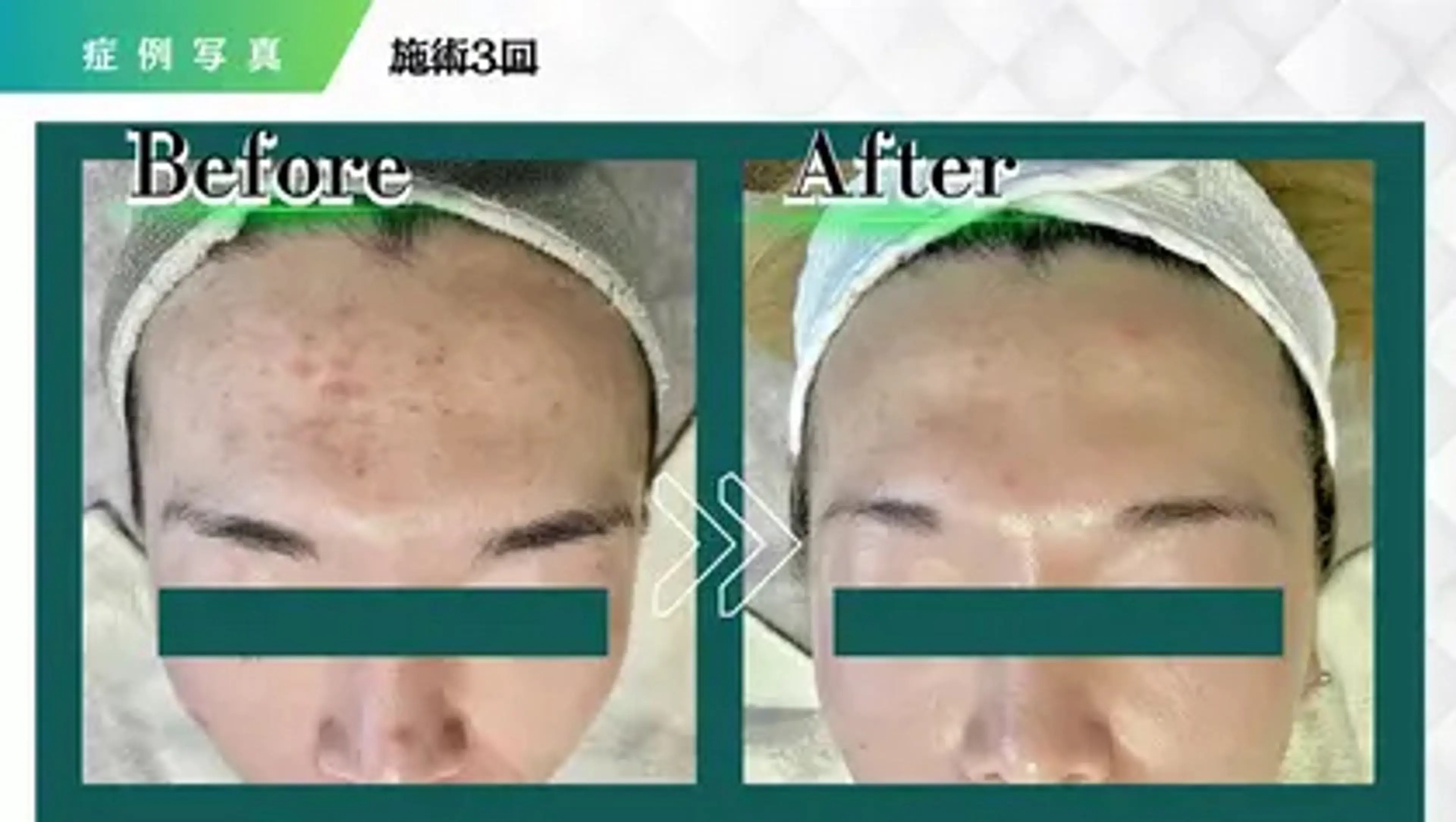 【人気No1★医師推奨/本格肌改善】幹細胞入りの独自のハーブピーリング×ハイドラ毛穴洗浄　目指せ赤ちゃん👶肌に！の写真