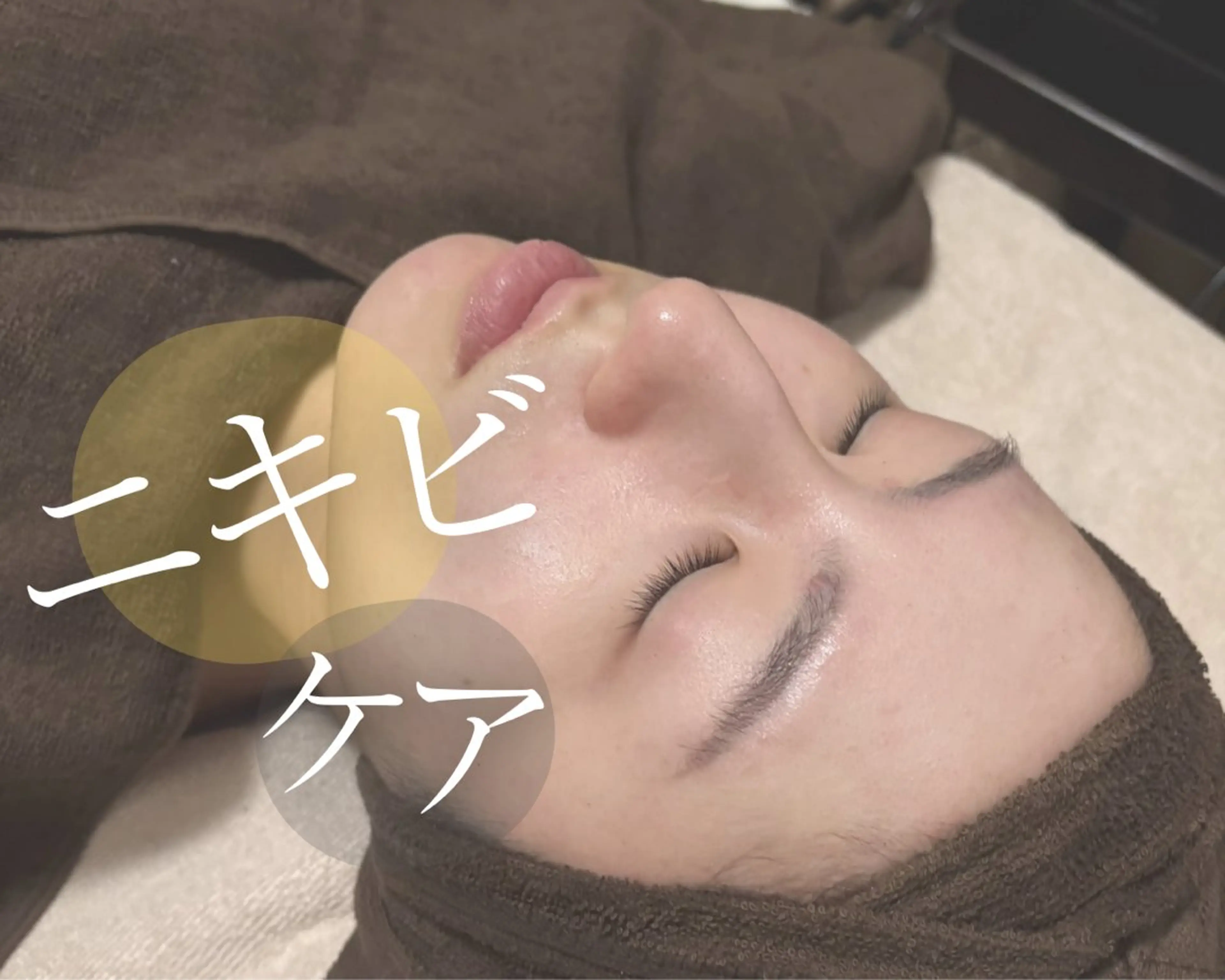 ニキビ撃退！毛穴洗浄+アクネ菌除去プラズマの写真