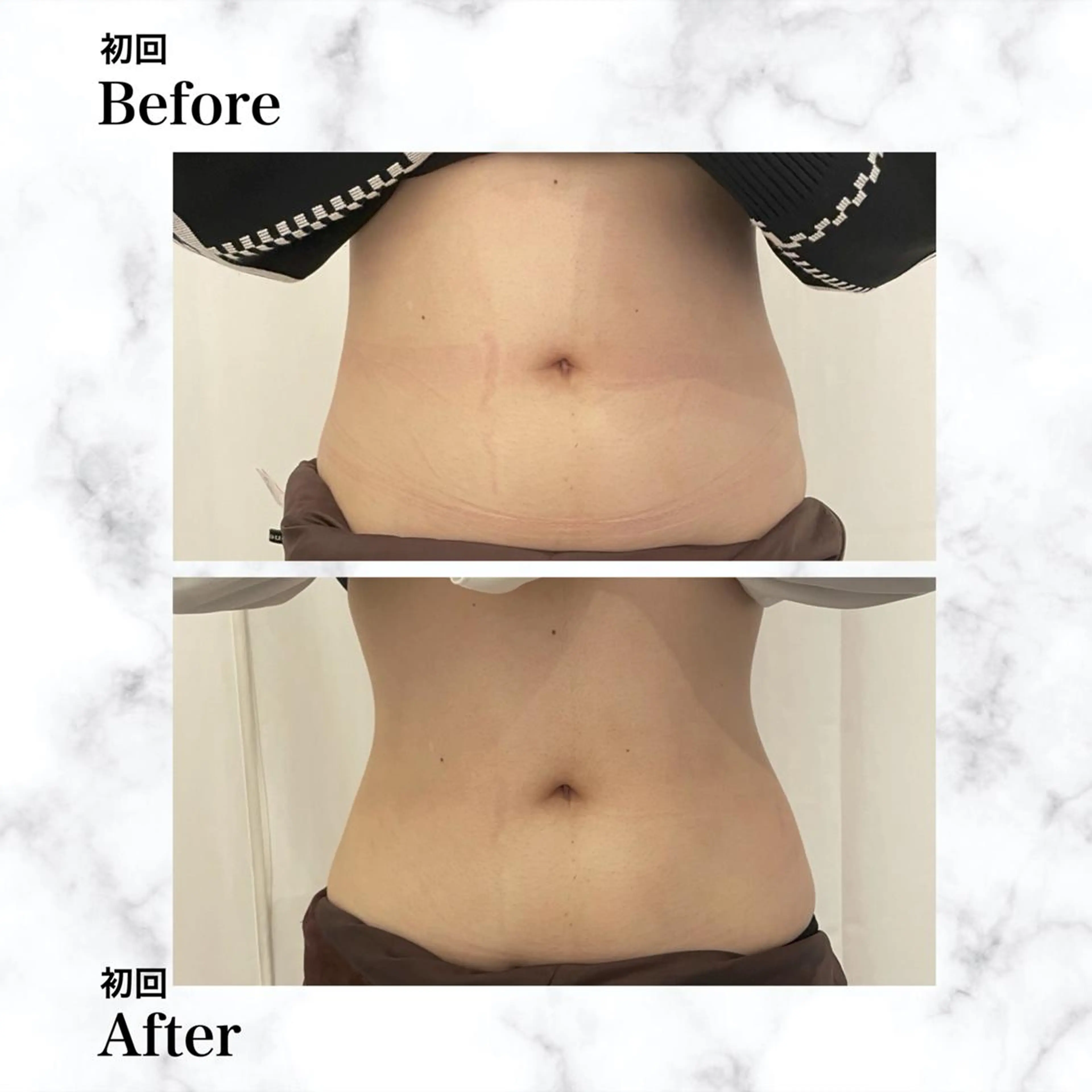 エステ リラク 12Dハイフ💗 最強小顔のエステ・リラクイメージ