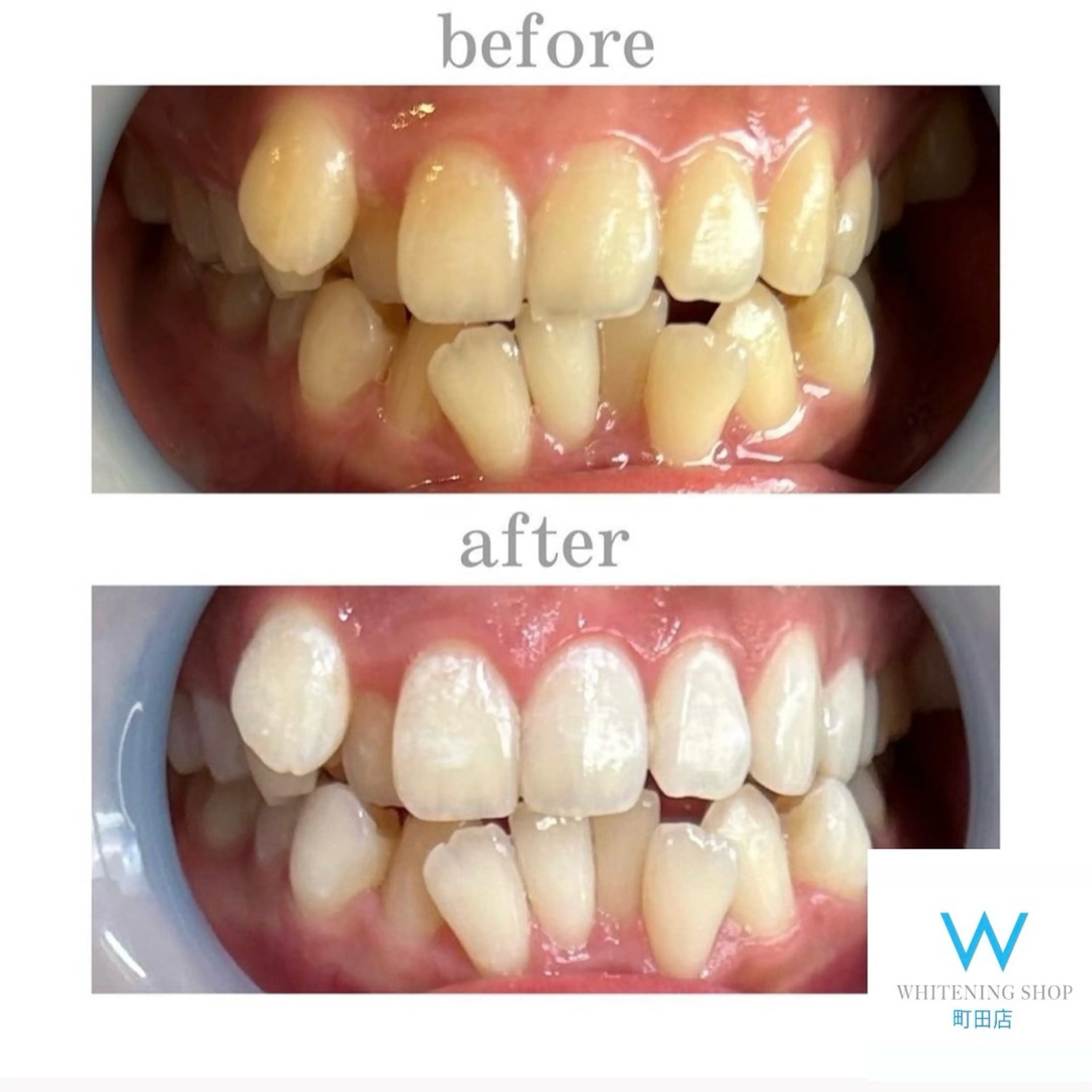 【カムバッククーポン】セルフホワイトニング1セット40分¥8980→¥3980の写真