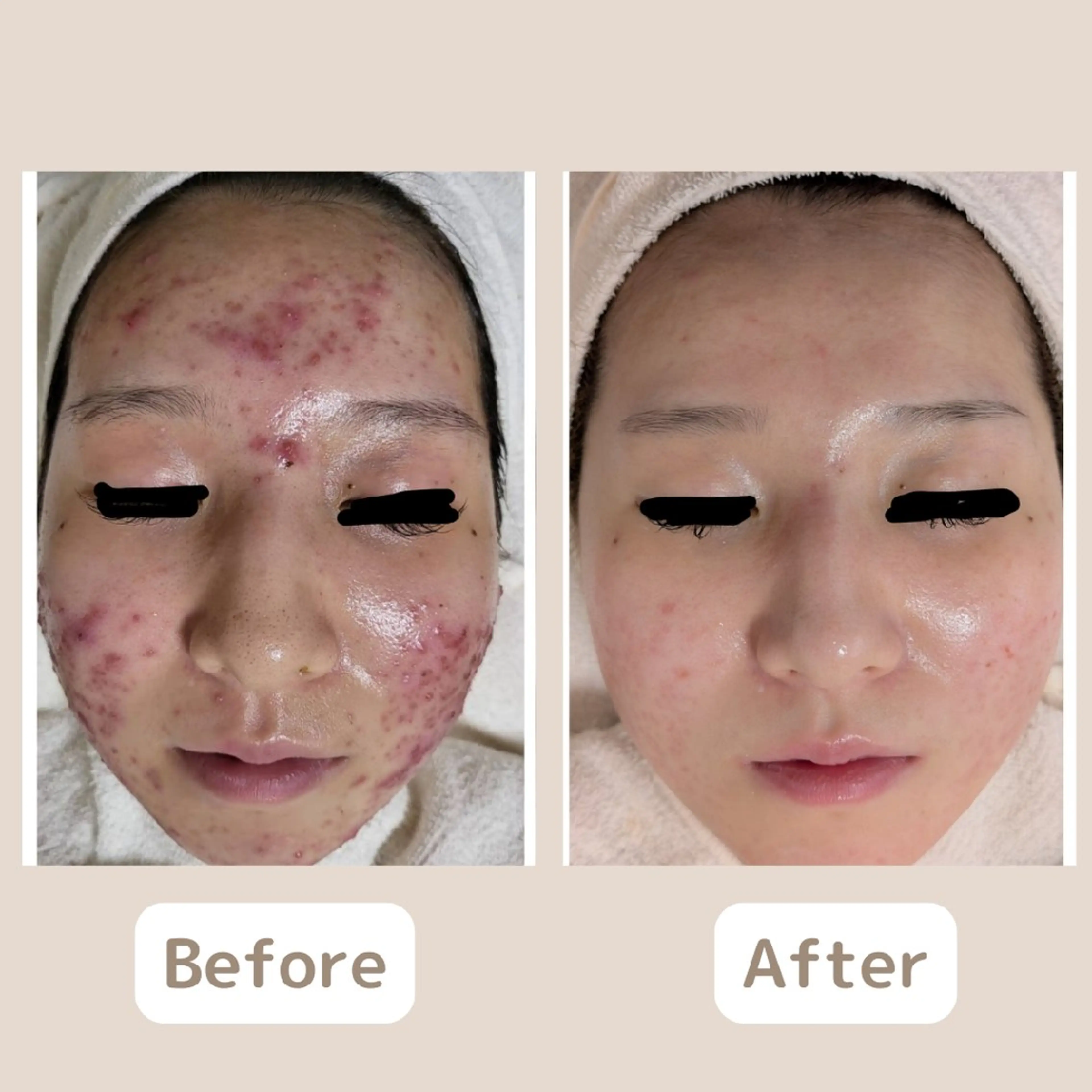 エステ 〈ニキビケアサロン〉 レゾン京橋店/ 浅川のエステ・リラクイメージ