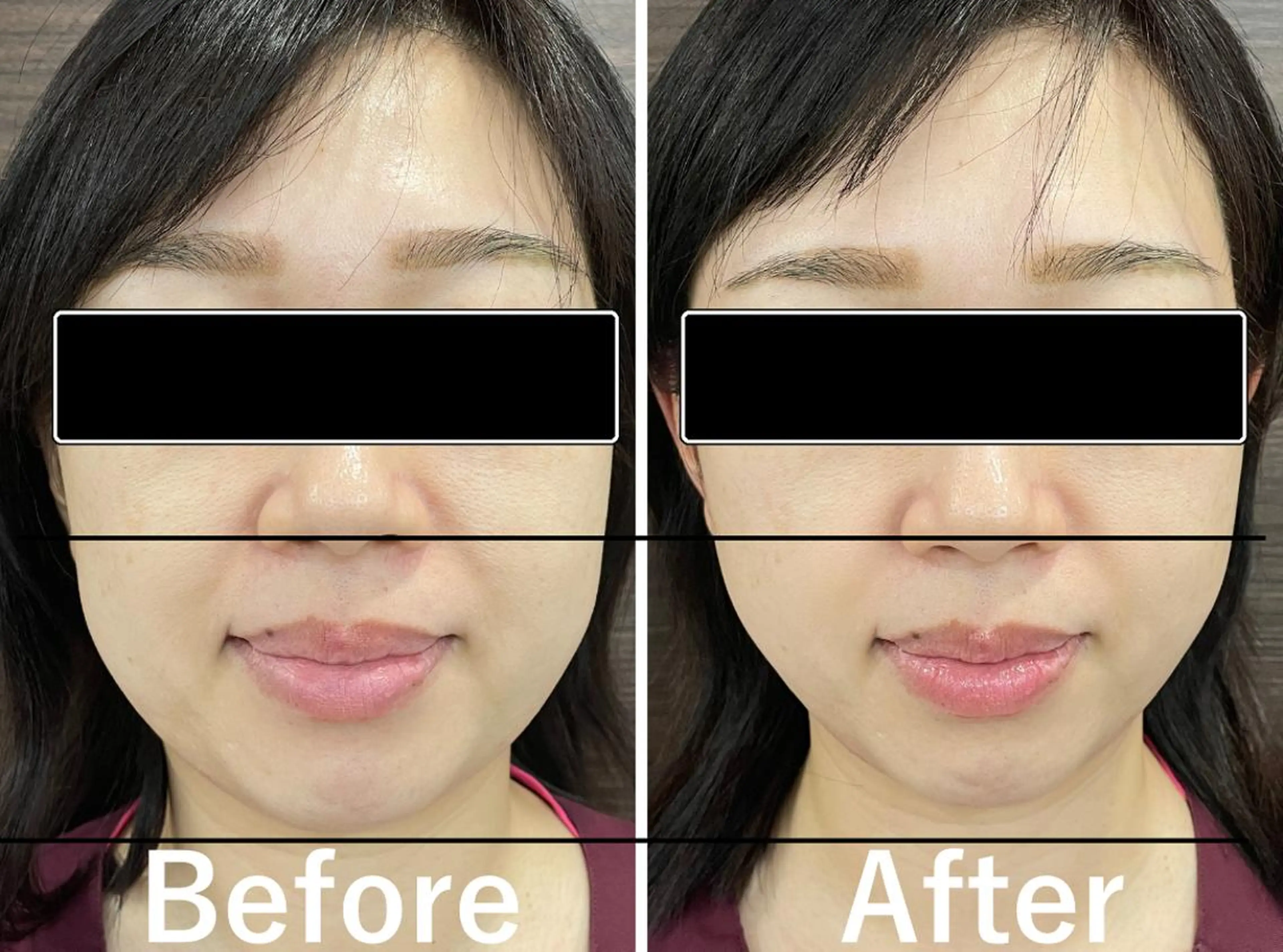 【美容鍼・小顔鍼】 鍼灸師　吉田洋美のエステ・リラクイメージ