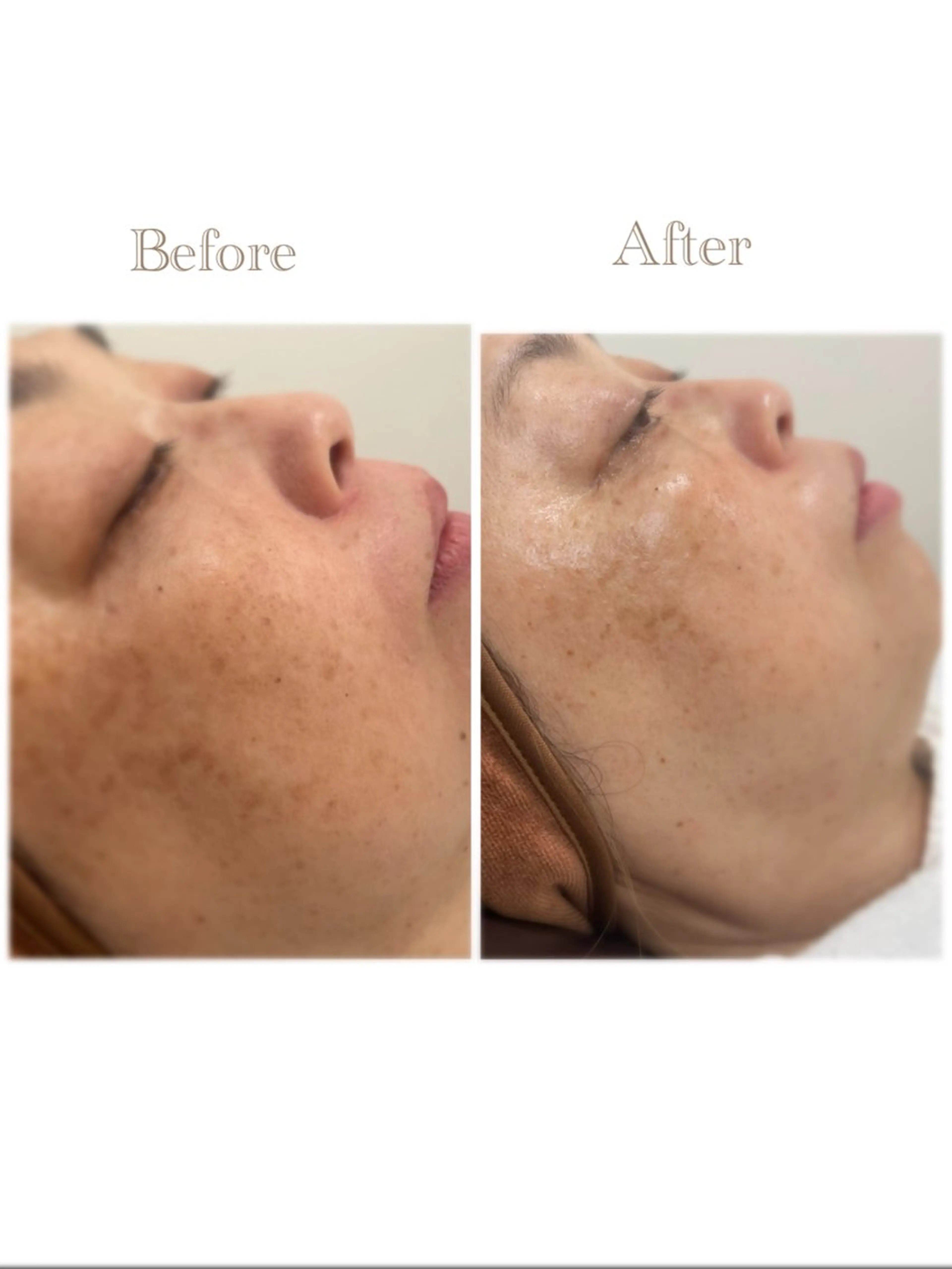 その他 お肌の角質ｹｱ / ﾍﾞﾗｽﾃｷﾞのその他イメージ