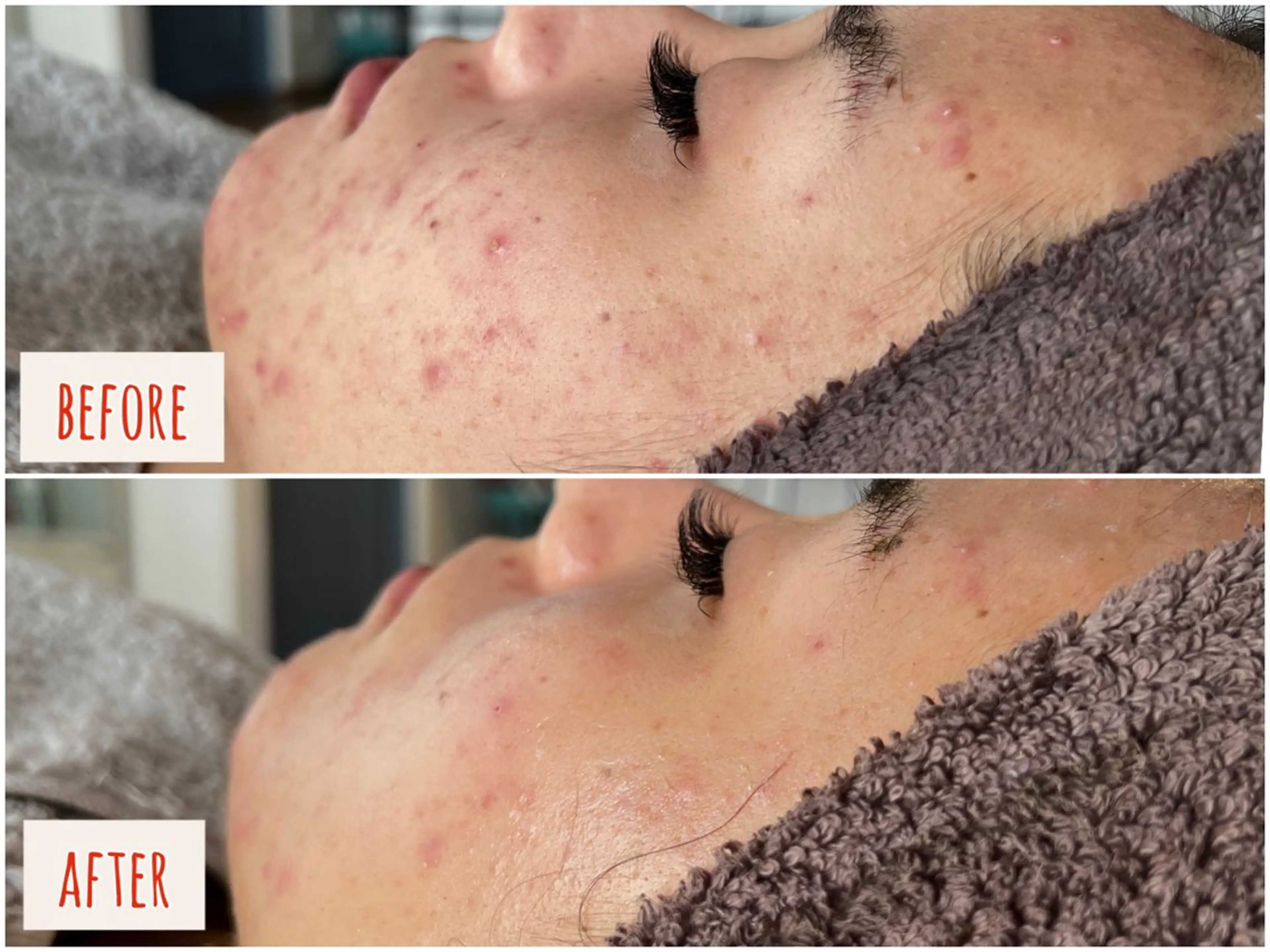 安心の看護師施術 ニキビ改善HAONのエステ・リラクイメージ