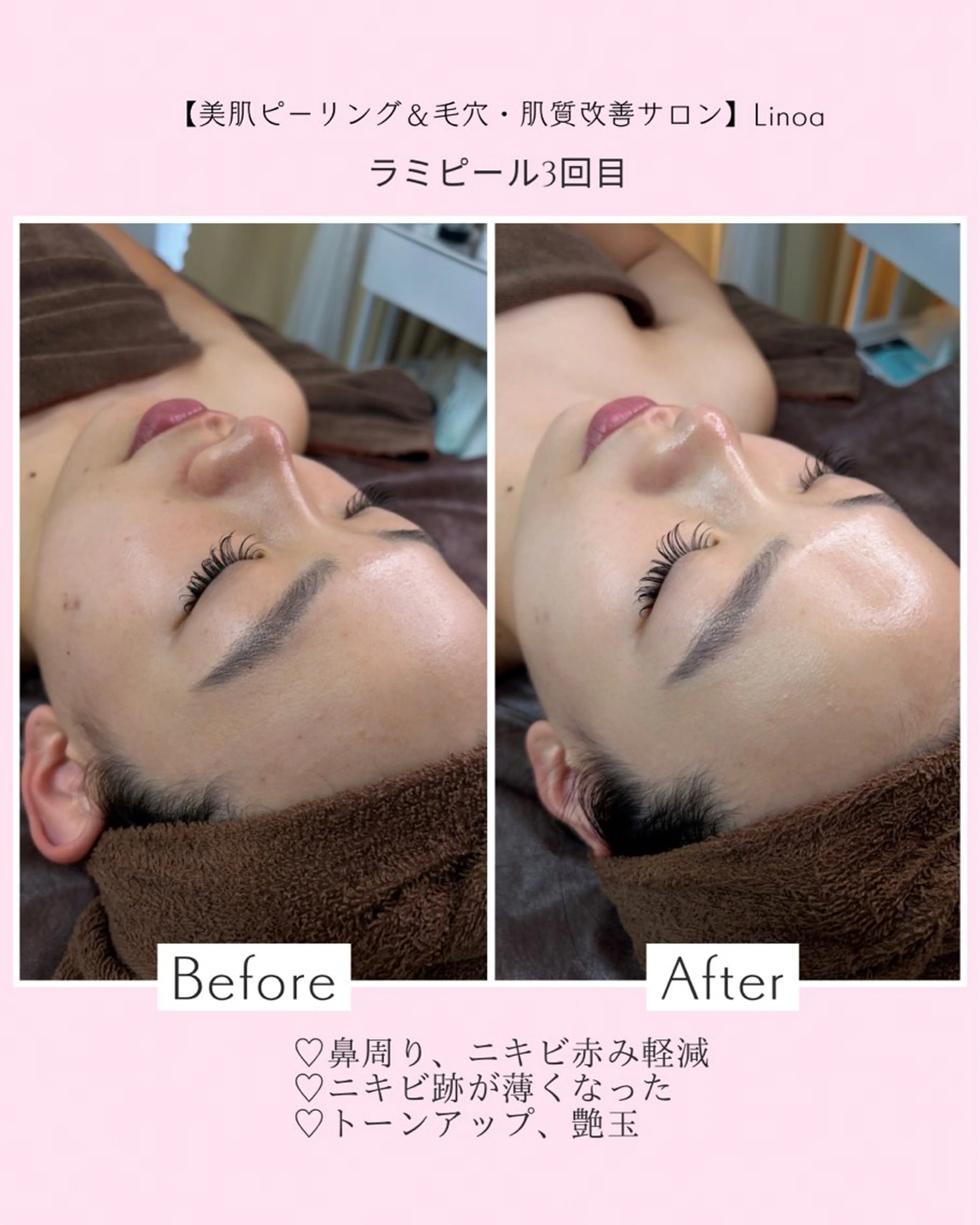 メンズ エステ Mr.&Ms.脱毛/ ピーリング/RINAのエステ・リラクイメージ