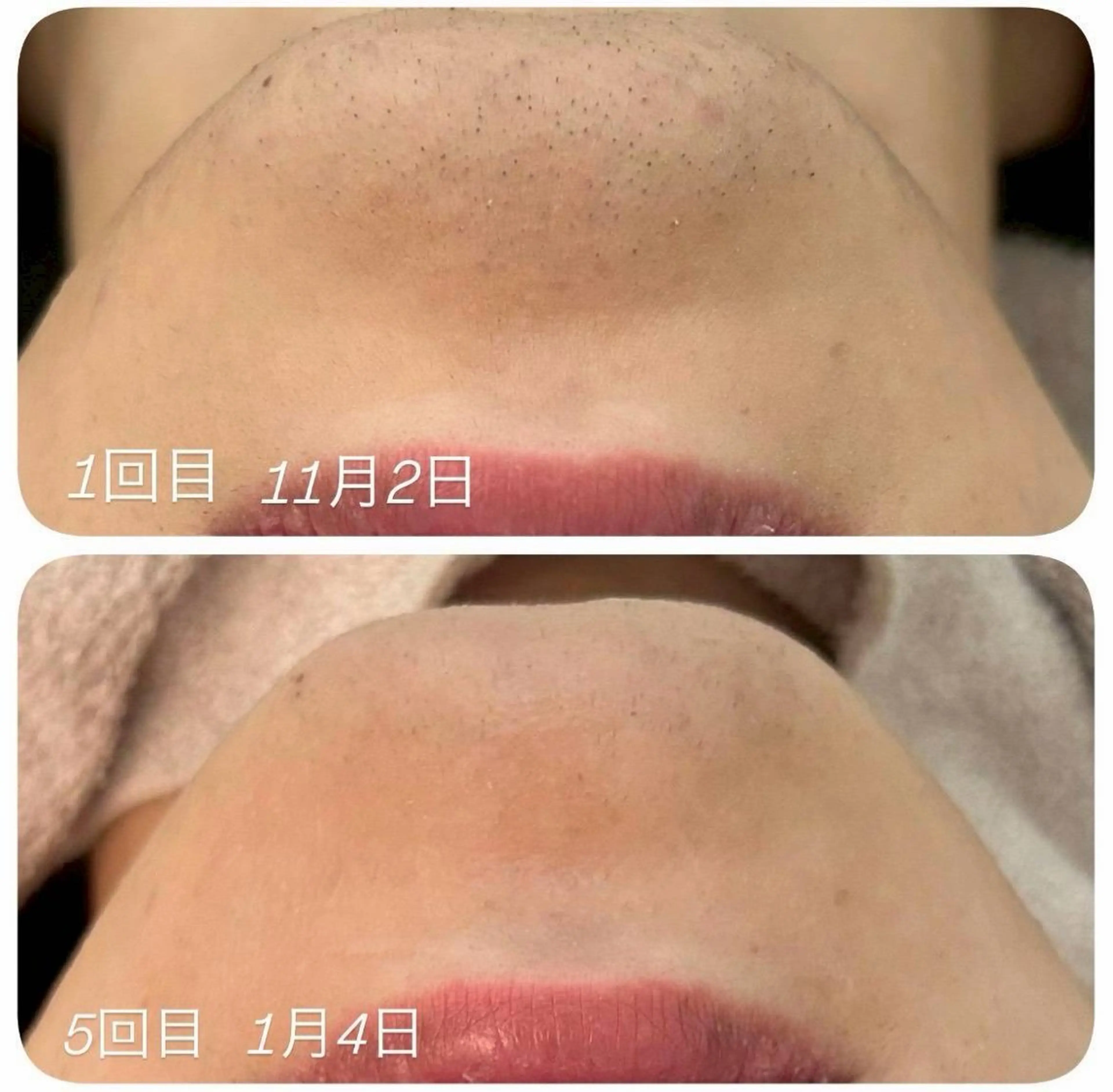 脱毛 uni. abeのエステ・リラクイメージ