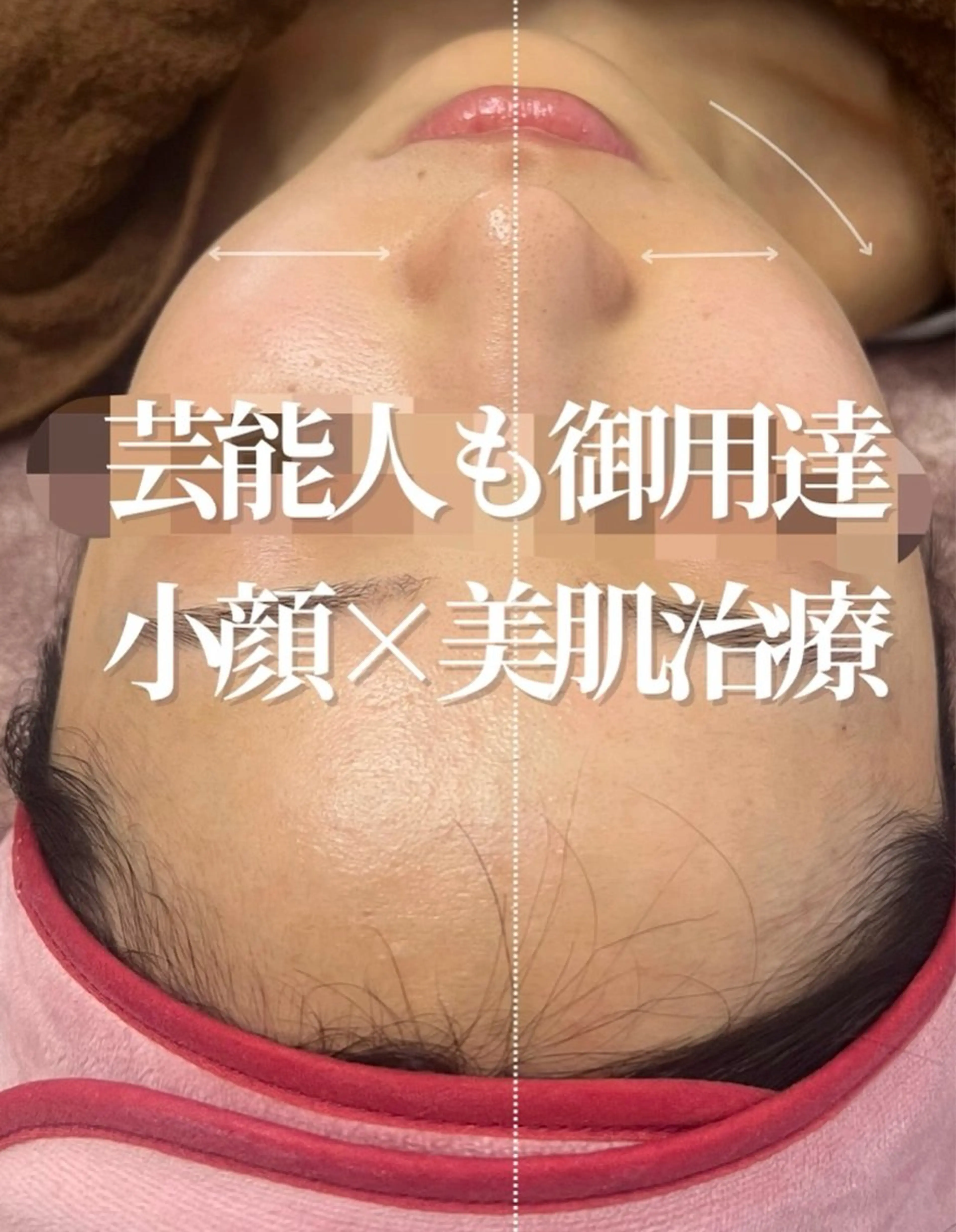 サロン版サーマクール💉✨最新美容【即効小顔】DTなし✨の写真