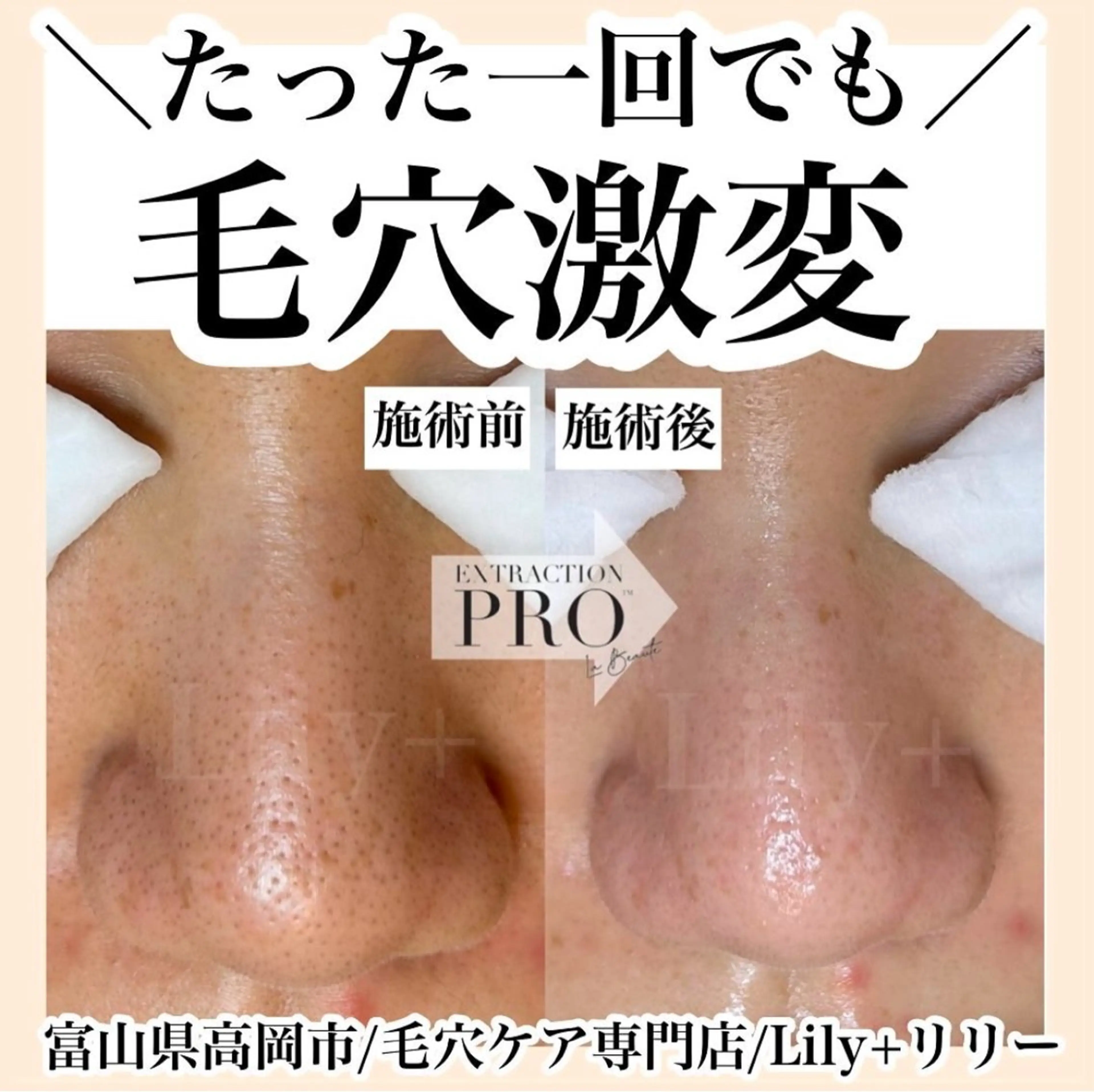 毛穴エステの写真