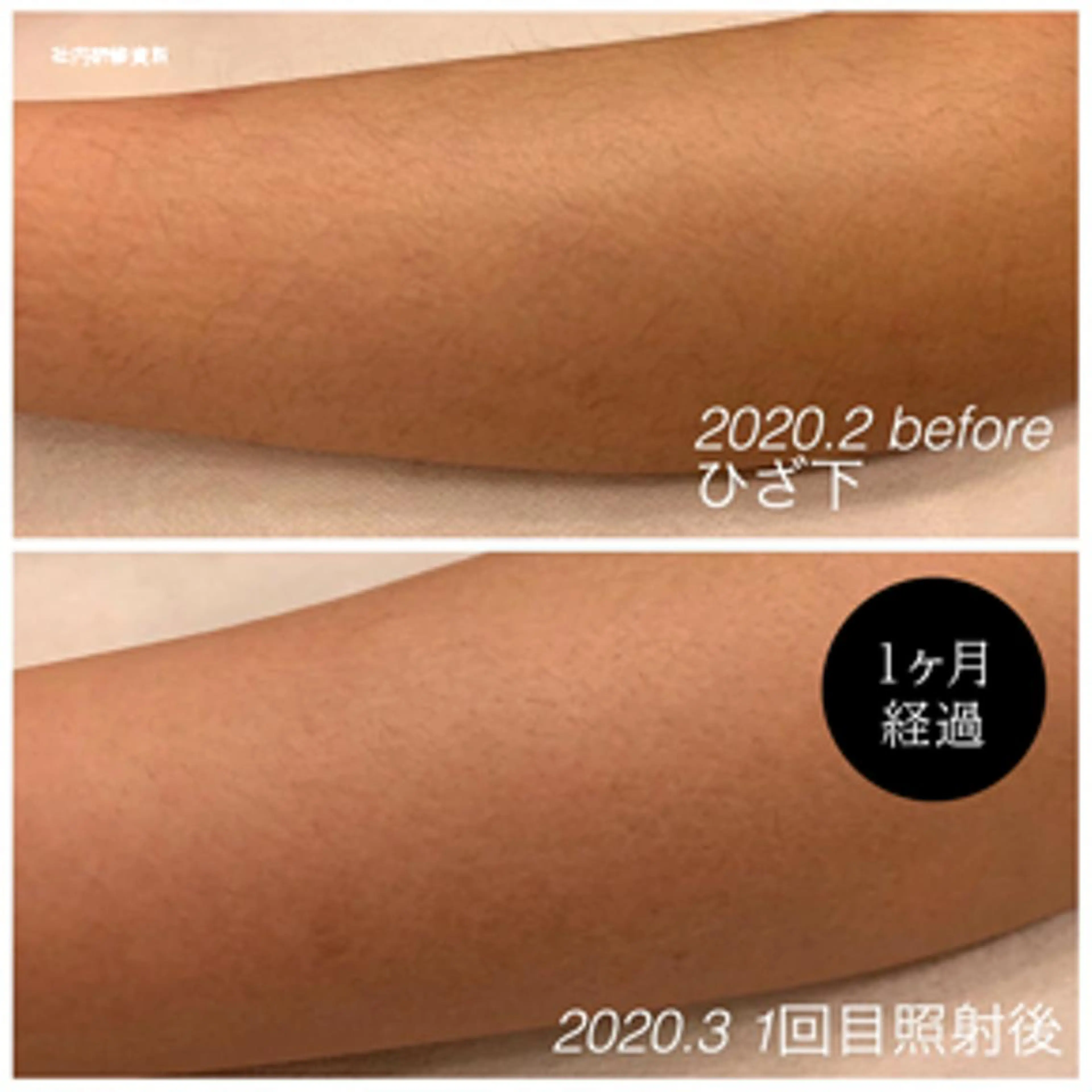 【スクール脱毛】　両アシ　￥2200の写真