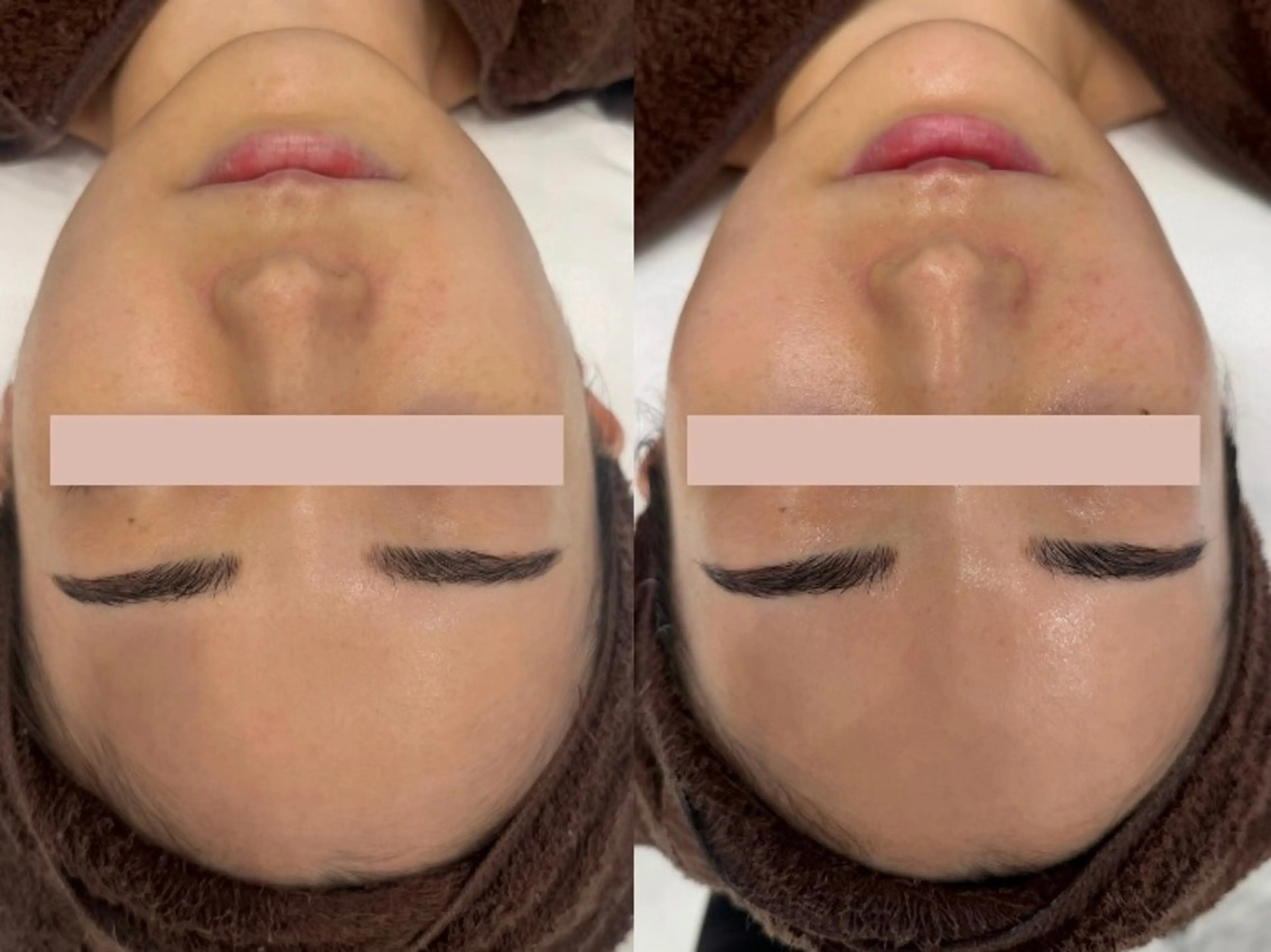 【小顔×毛穴】小顔リンパマッサージ＆毛穴洗浄ハイドラフェイシャル＆潤うコラーゲンパック¥22,000→¥9990の写真