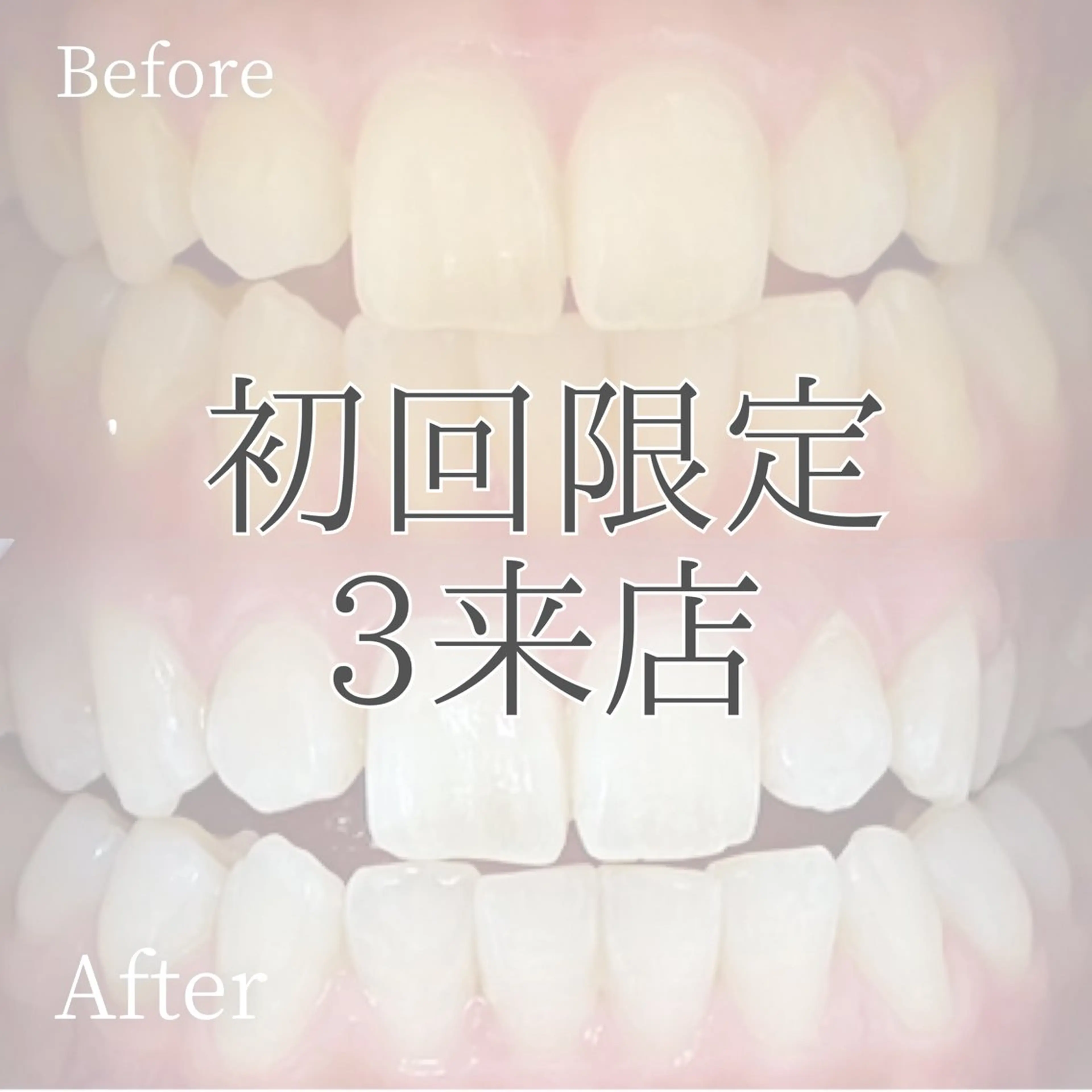 【ミニモ限定✨】3来店チケット通常¥20,940→¥12,000👀ホワイトニングの良さを知ってください❗️の写真